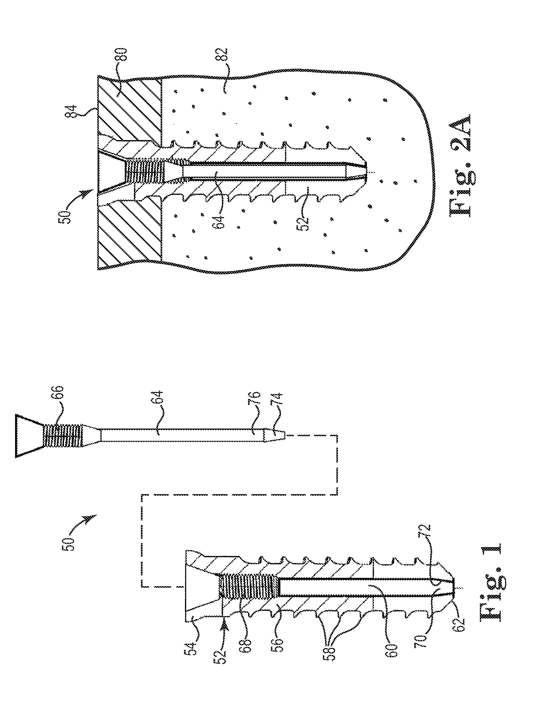 Fixation System for Orthopedic Devices