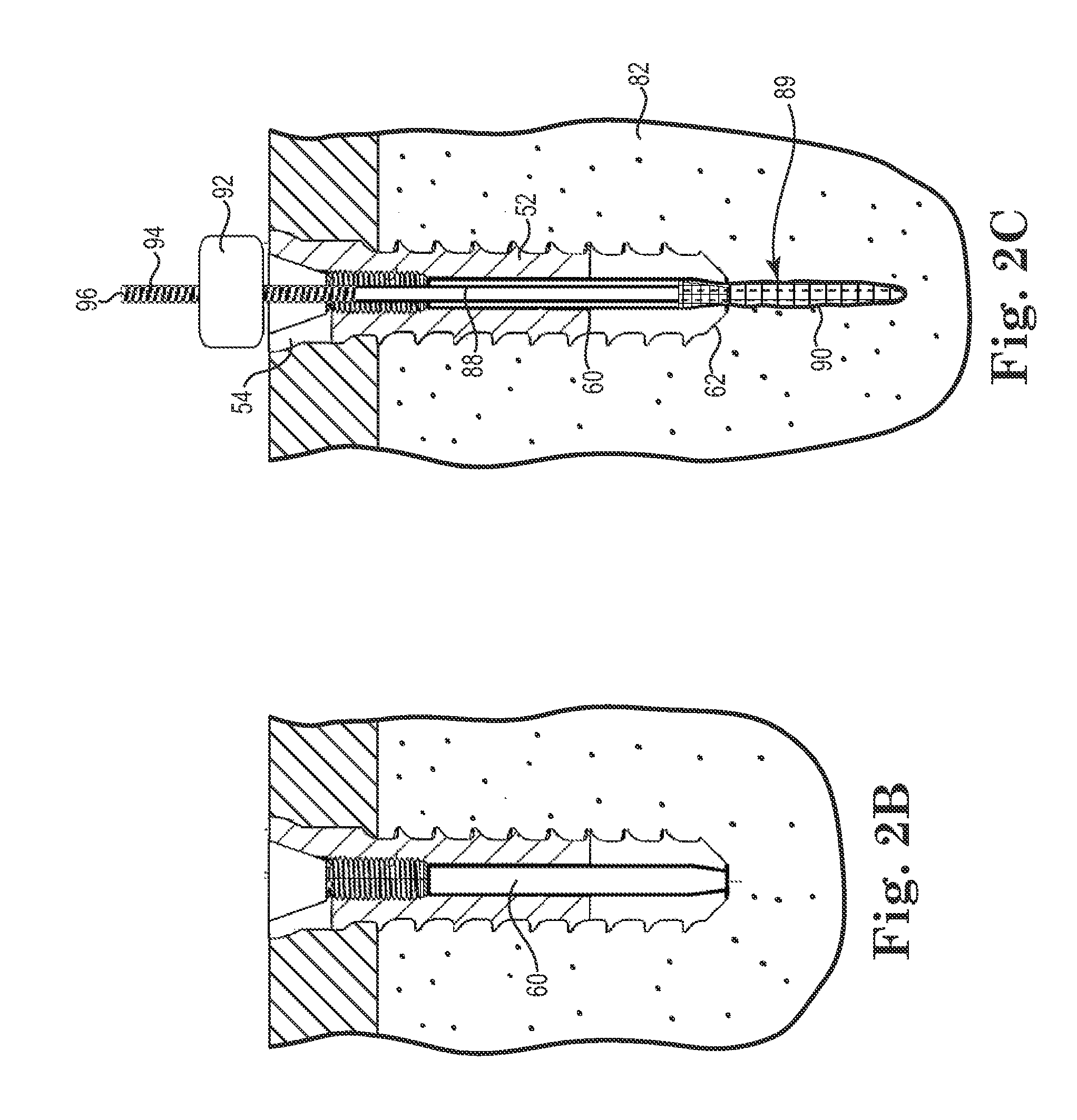 Fixation System for Orthopedic Devices