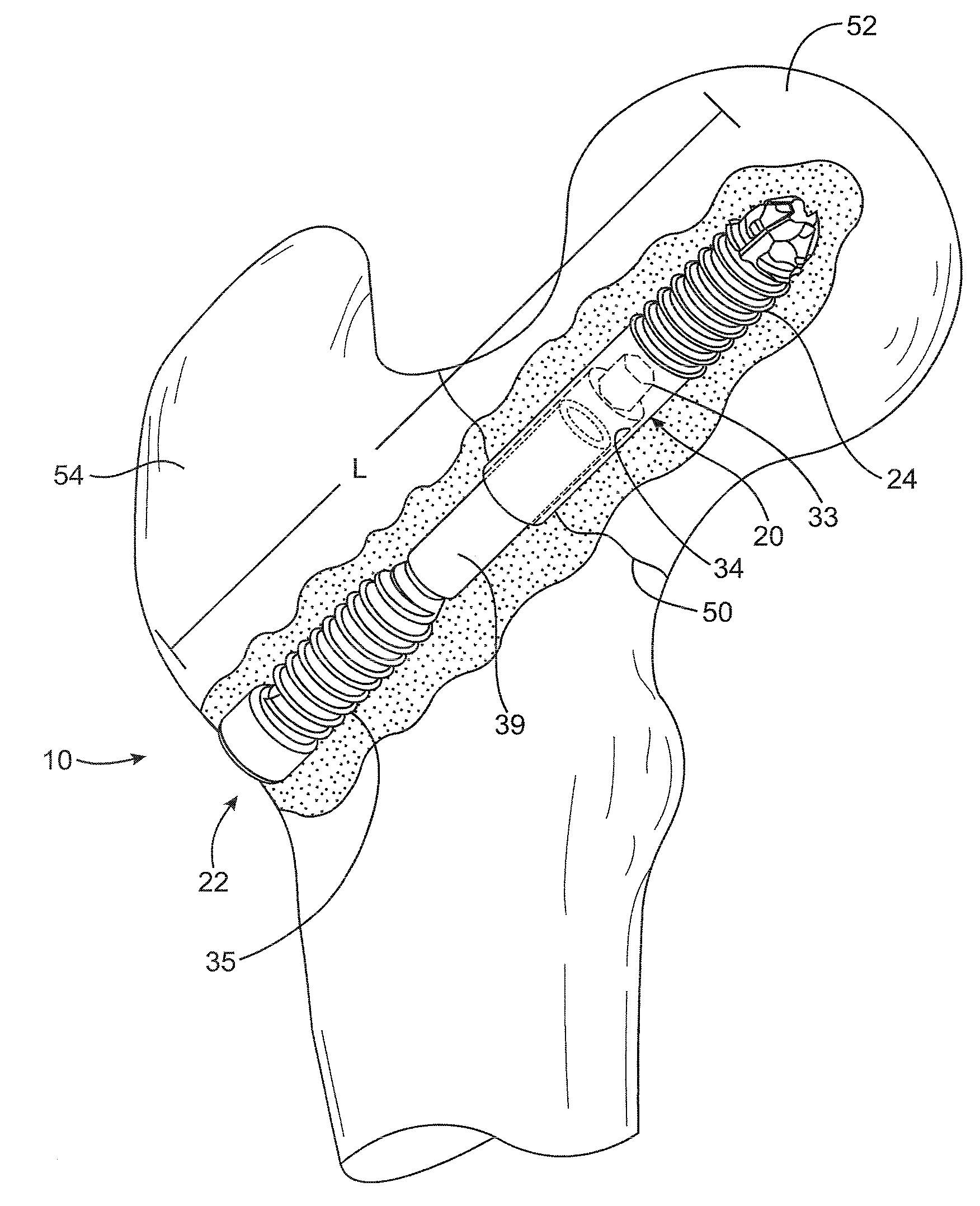Collapsible bone screw apparatus