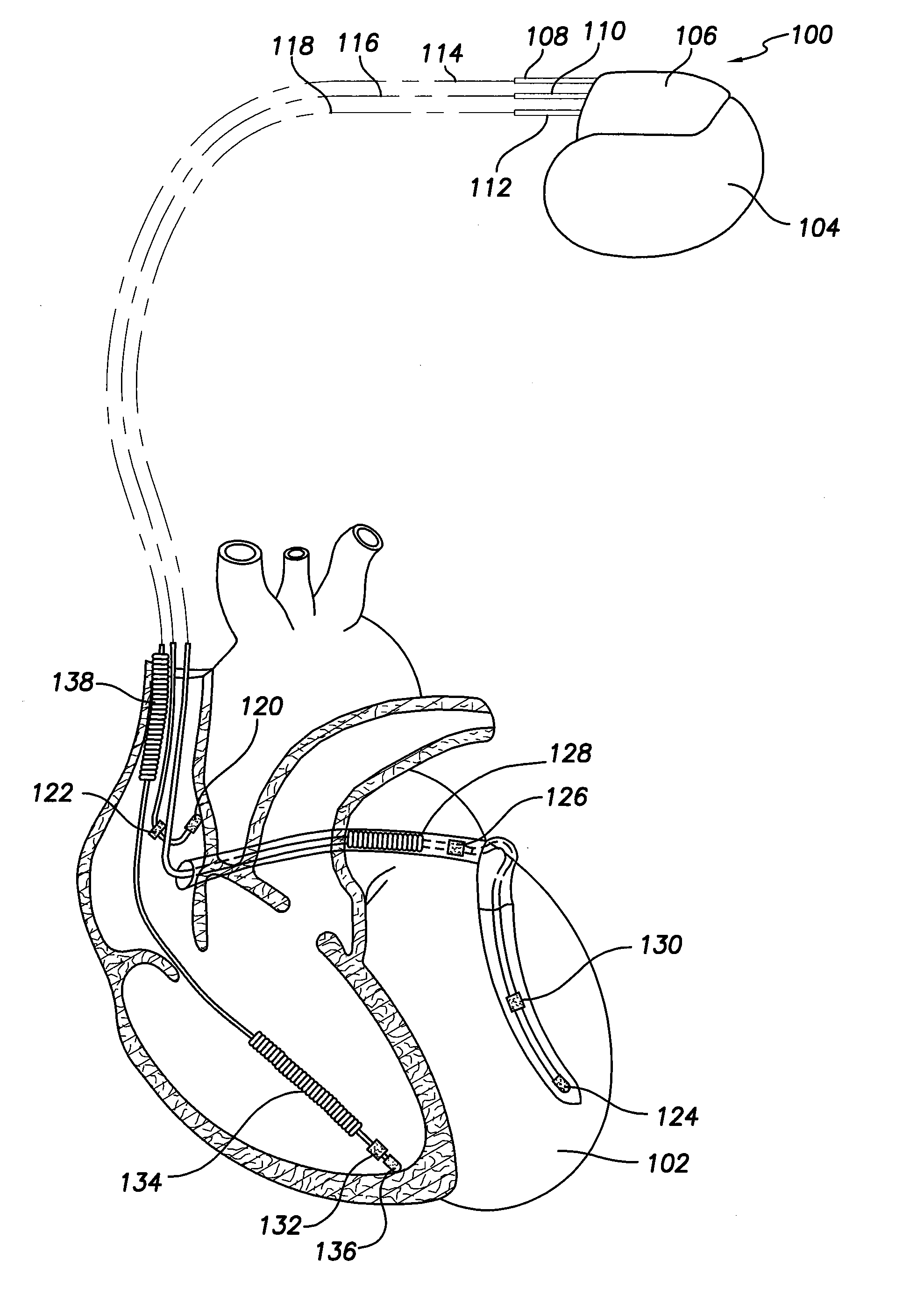 Methods and Systems for Discriminating Between Ventricular Waveforms When Ventricular Rate Exceeds Atrial Rate
