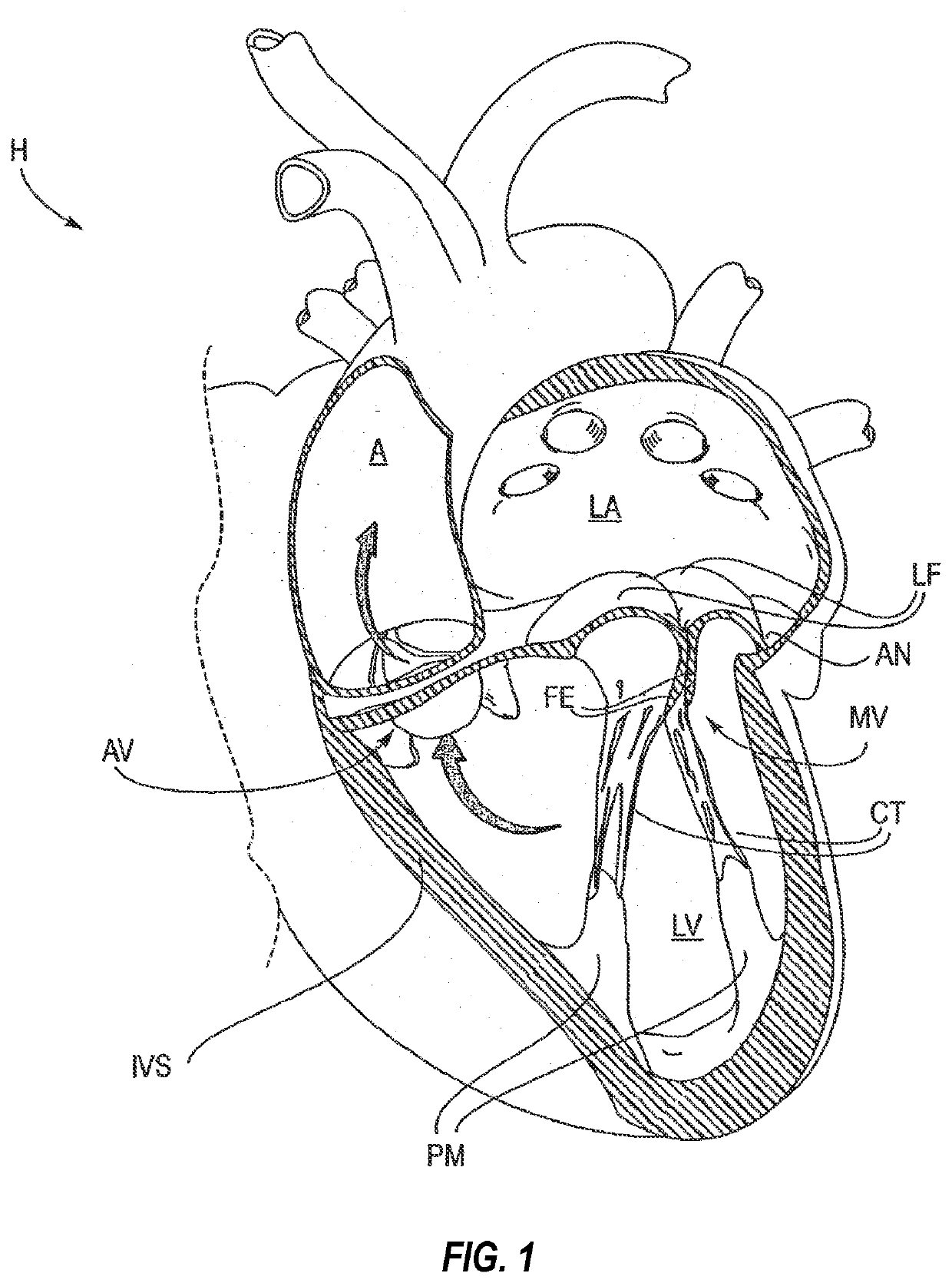 Systems, apparatuses, and methods for removing a medical implant from cardiac tissue