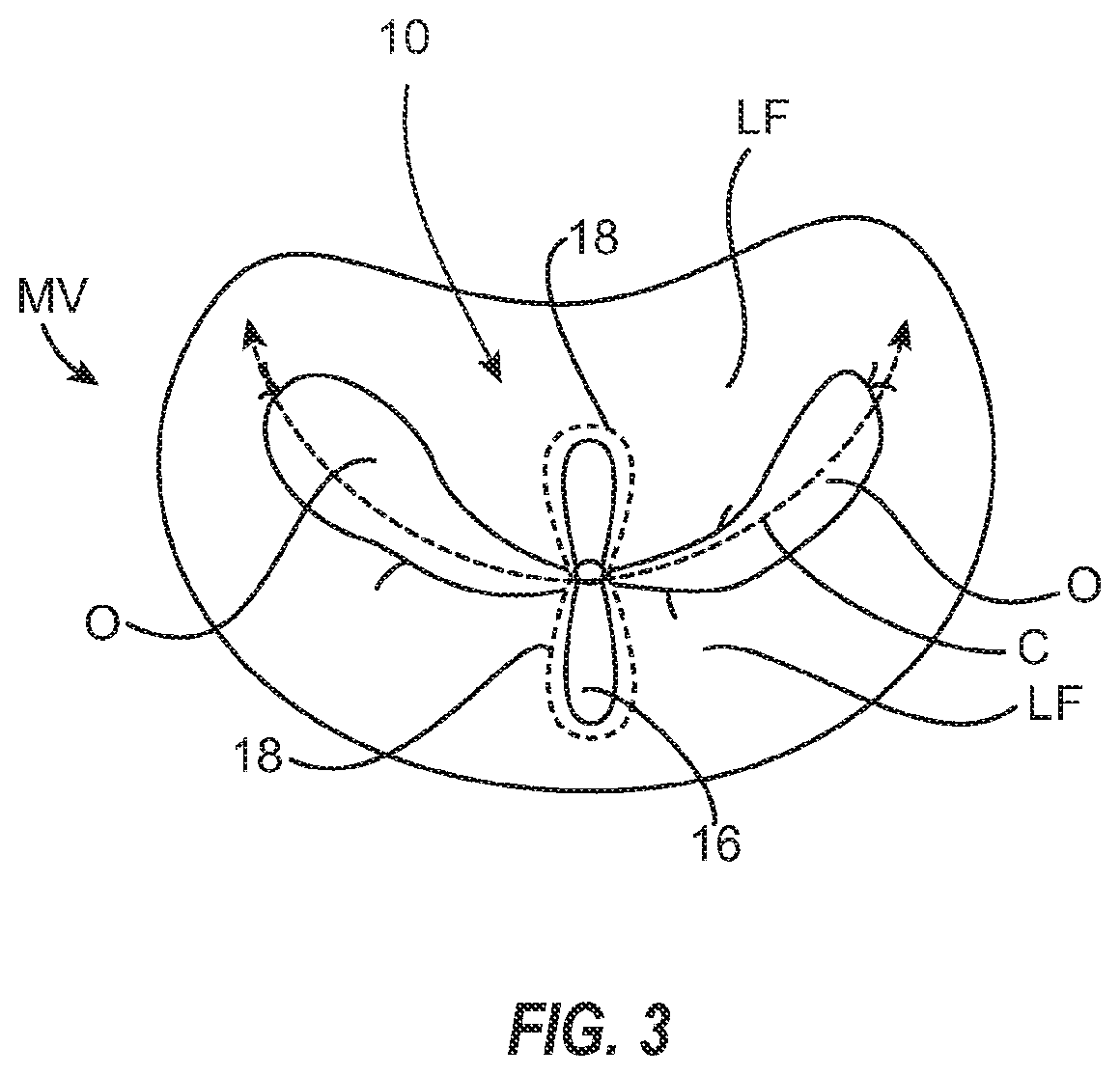 Systems, apparatuses, and methods for removing a medical implant from cardiac tissue
