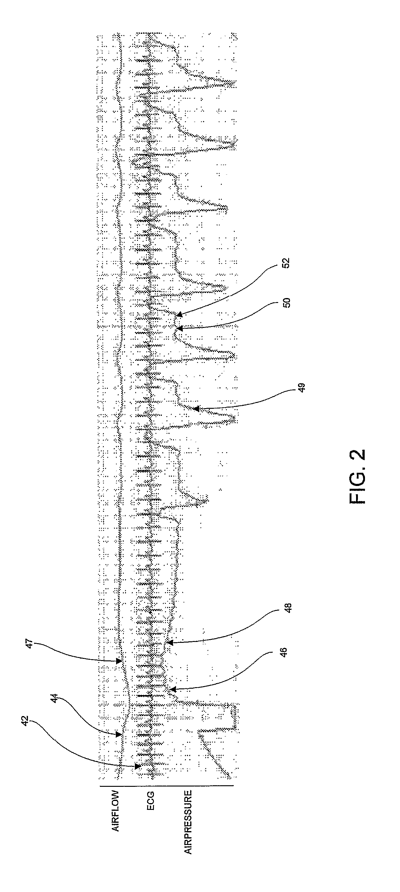 Cardiac monitoring and therapy using a device for providing pressure treatment of sleep disordered breathing