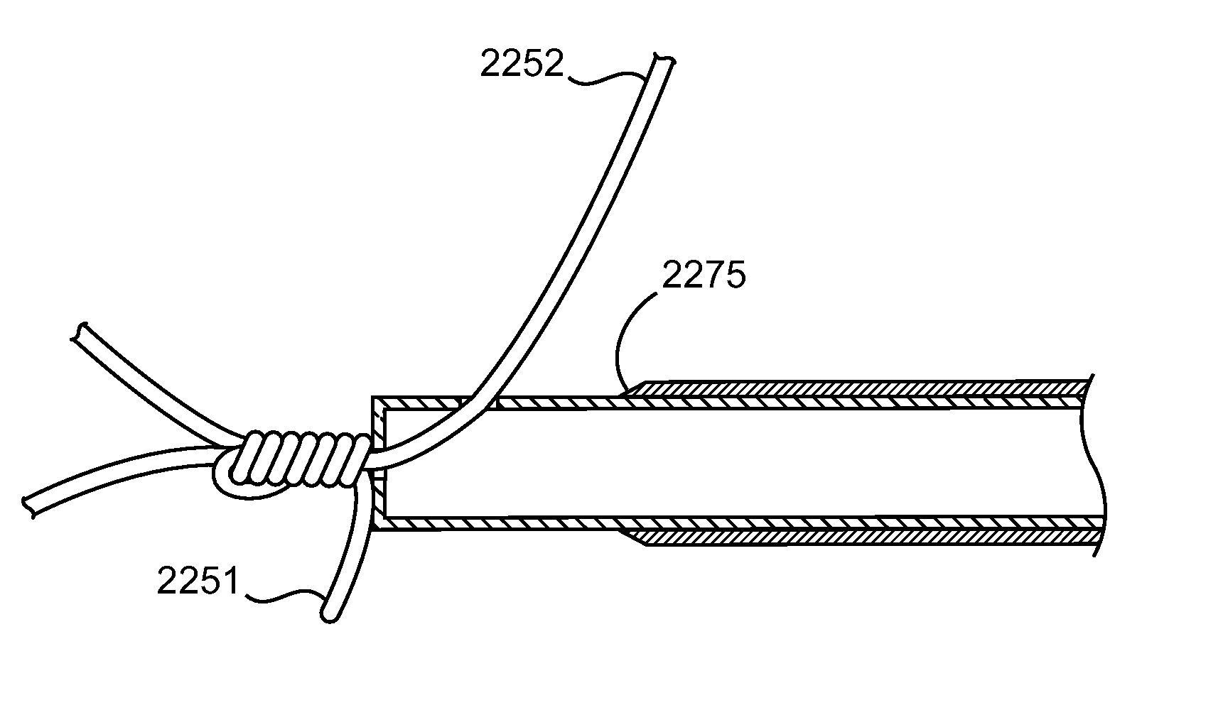 Minimally Invasive Procedure for Implanting an Annuloplasty Device