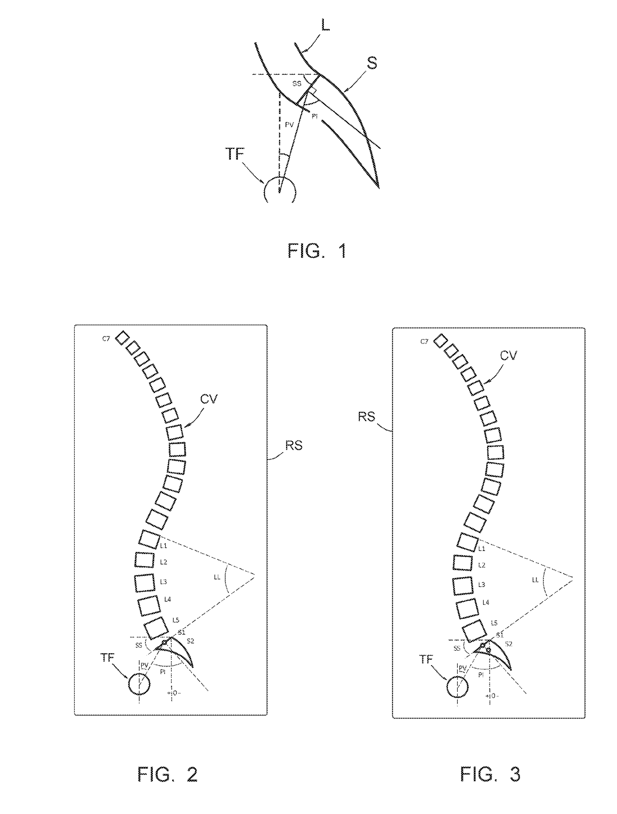 Method making it possible to produce the ideal curvature of a rod of vertebral osteosynthesis material designed to support a patient vertebral column