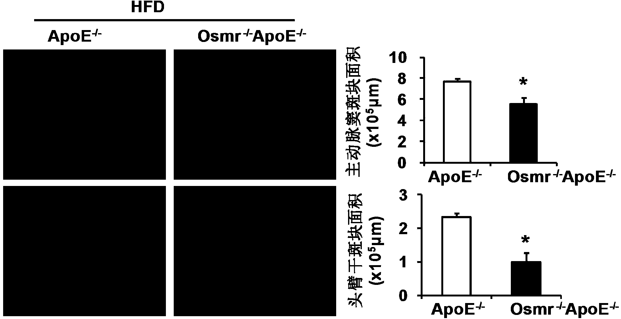 Function and application of II-type oncostatin M receptor in treating atherosclerosis