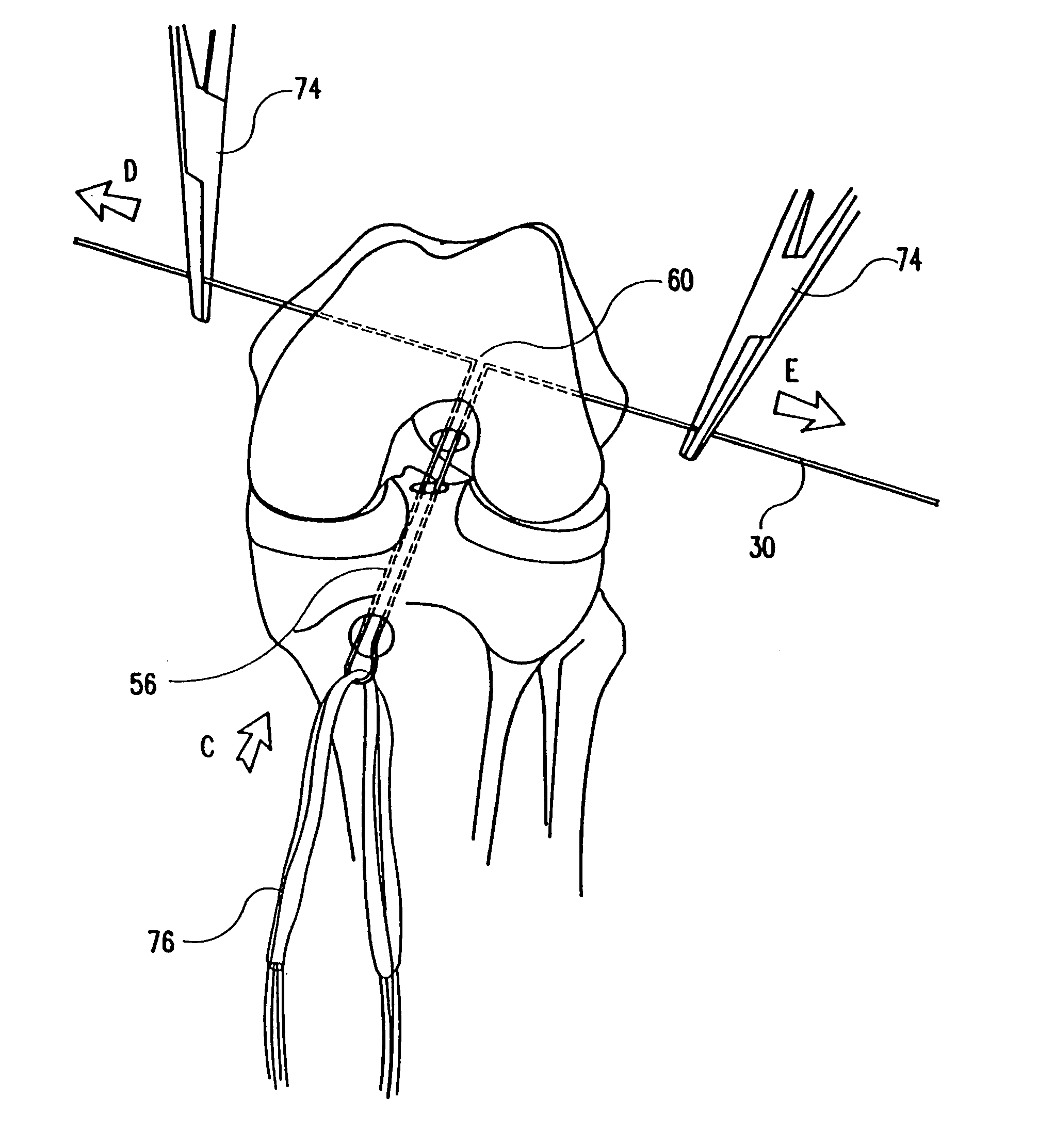 Method of loading tendons into the knee
