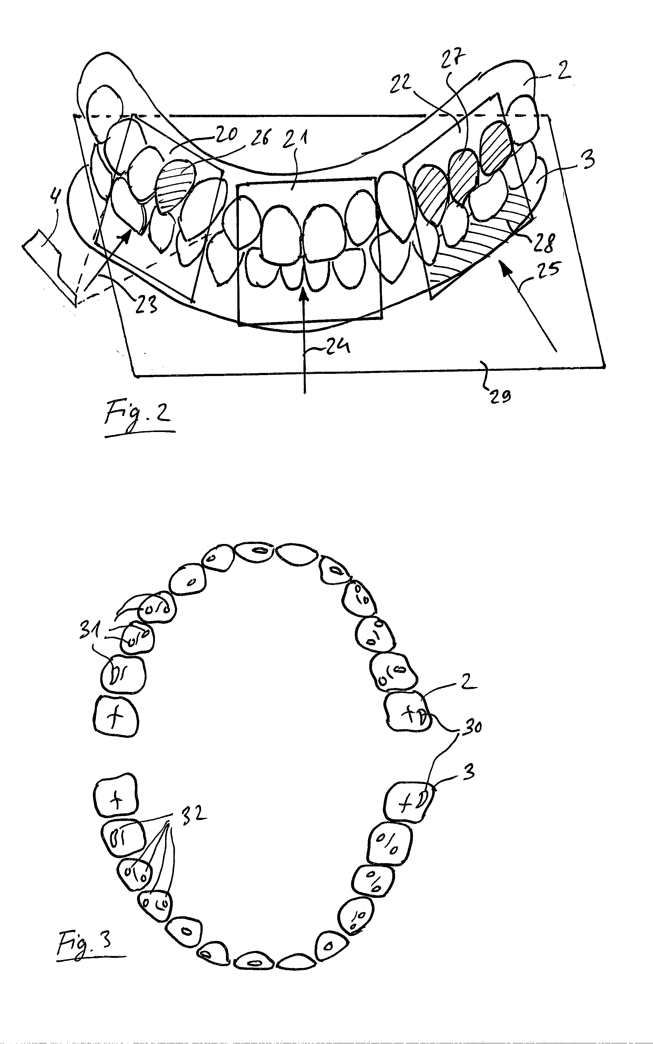 Method for recording individual three-dimensional optical images to form a global image of a tooth situation