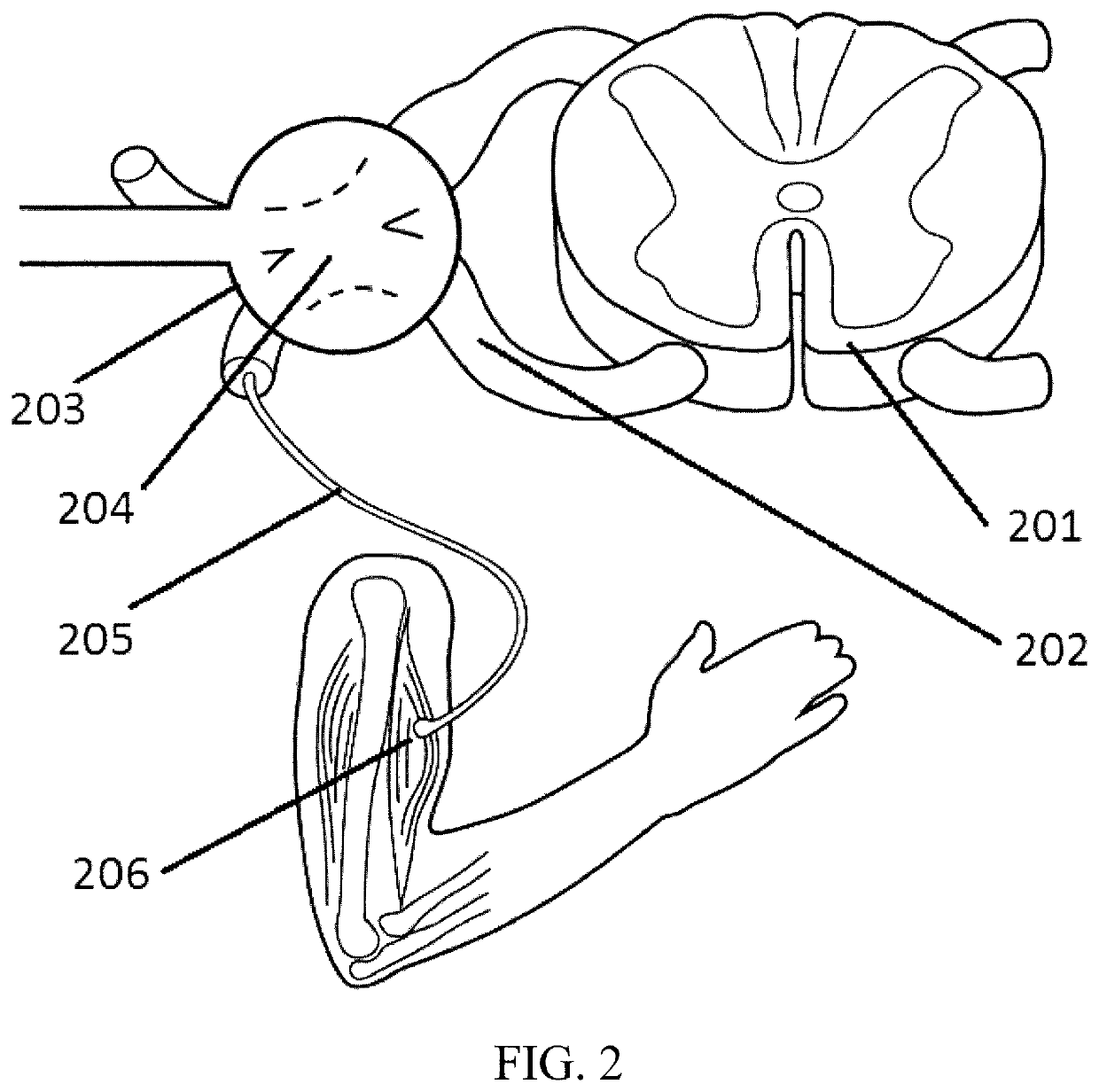 Systems and methods for spasticity treatment using spinal nerve magnetic stimulation