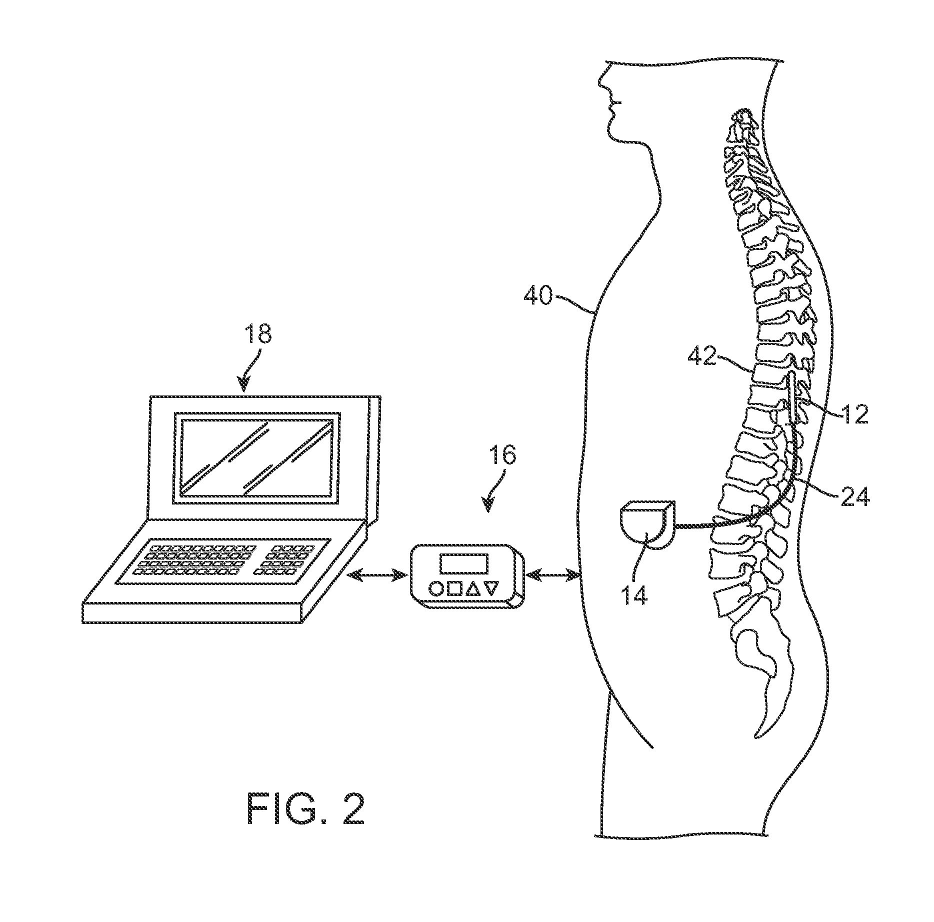 Method and device for acquiring physiological data during tissue stimulation procedure