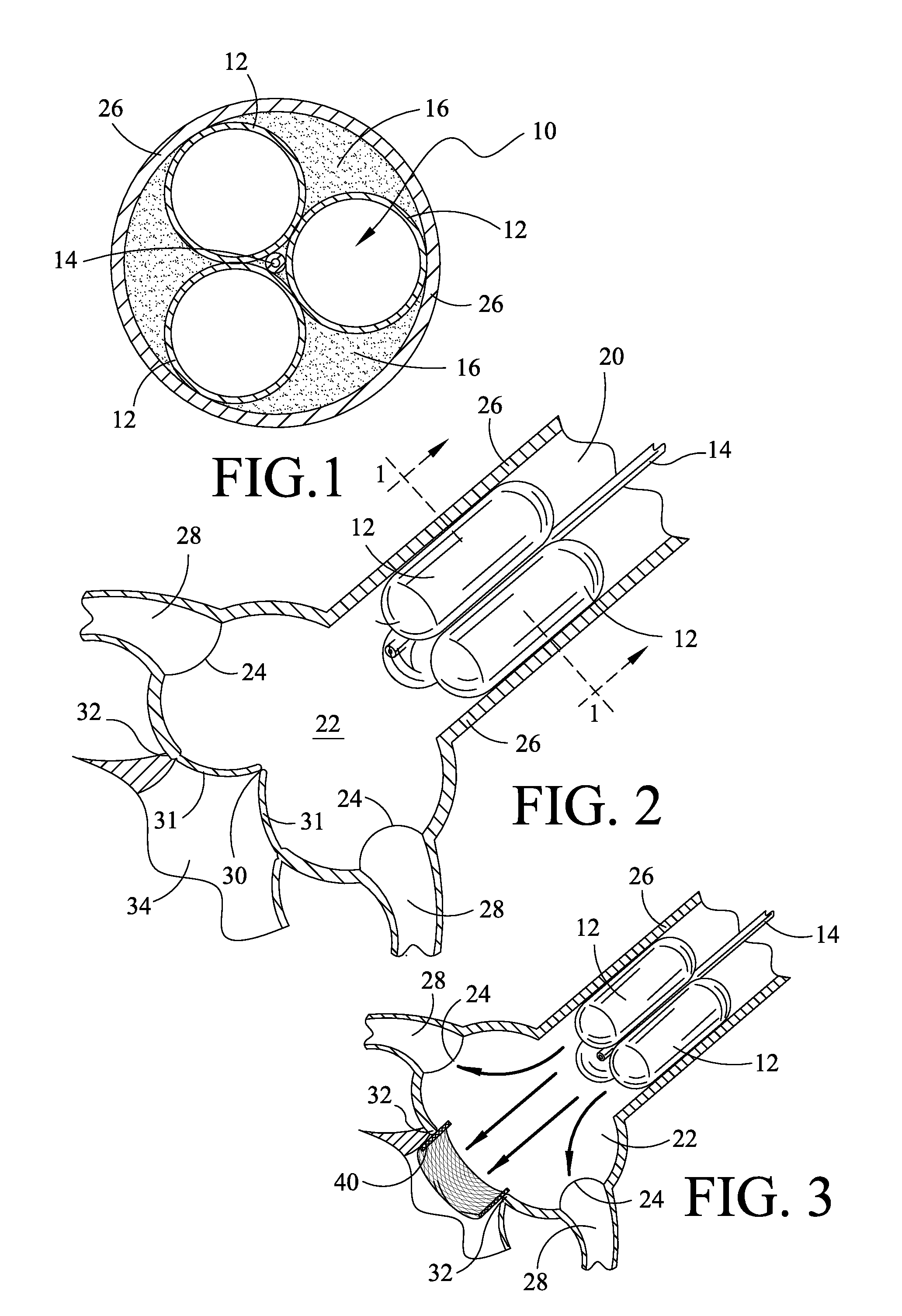 Method and apparatus for percutaneous aortic valve replacement