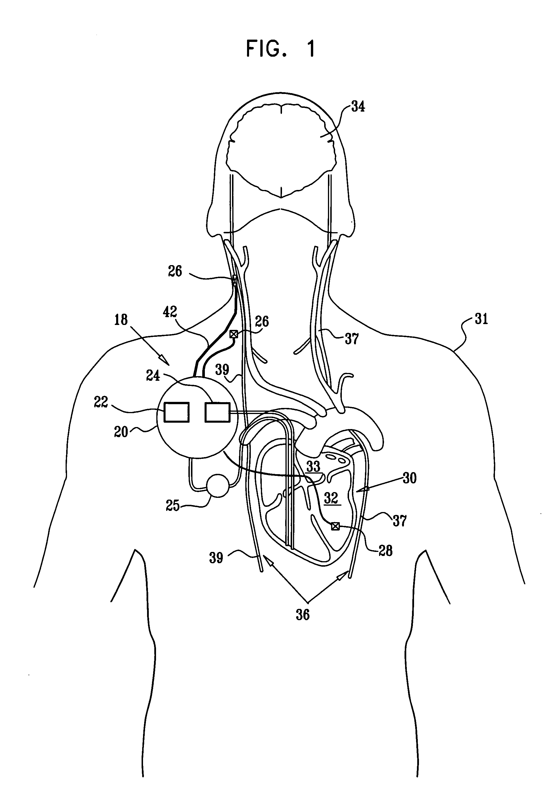 Method for surgically implanting an electrode device