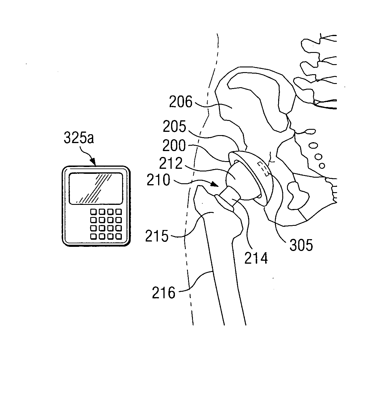 Methods for detecting osteolytic conditions in the body