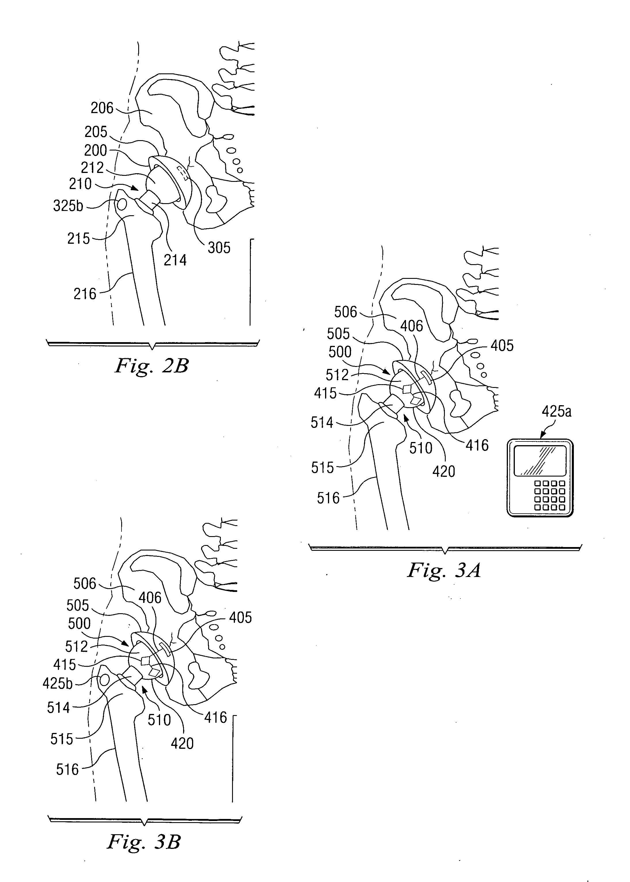 Methods for detecting osteolytic conditions in the body