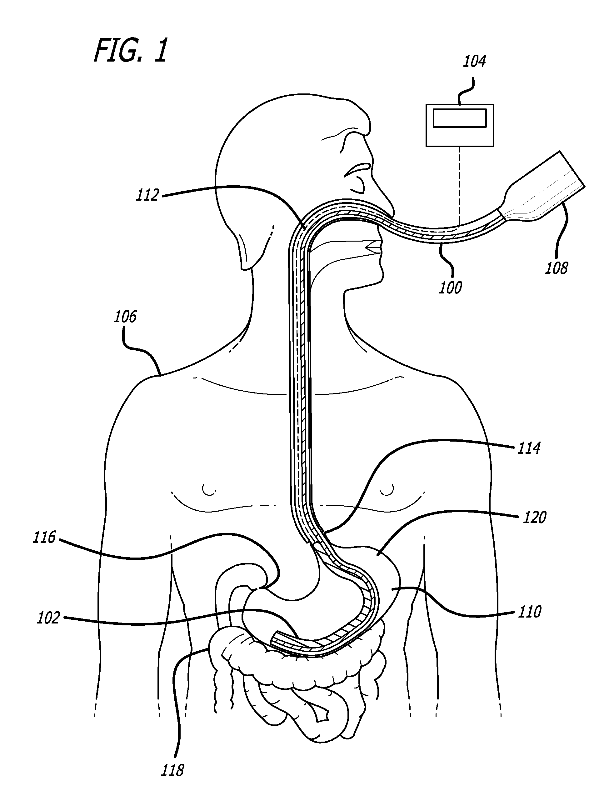 NG tube with gastric volume detection