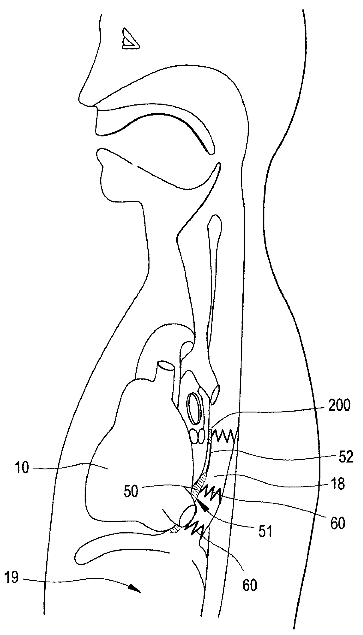 Implantable Devices and Methods for Stimulation of Cardiac or Other Tissues