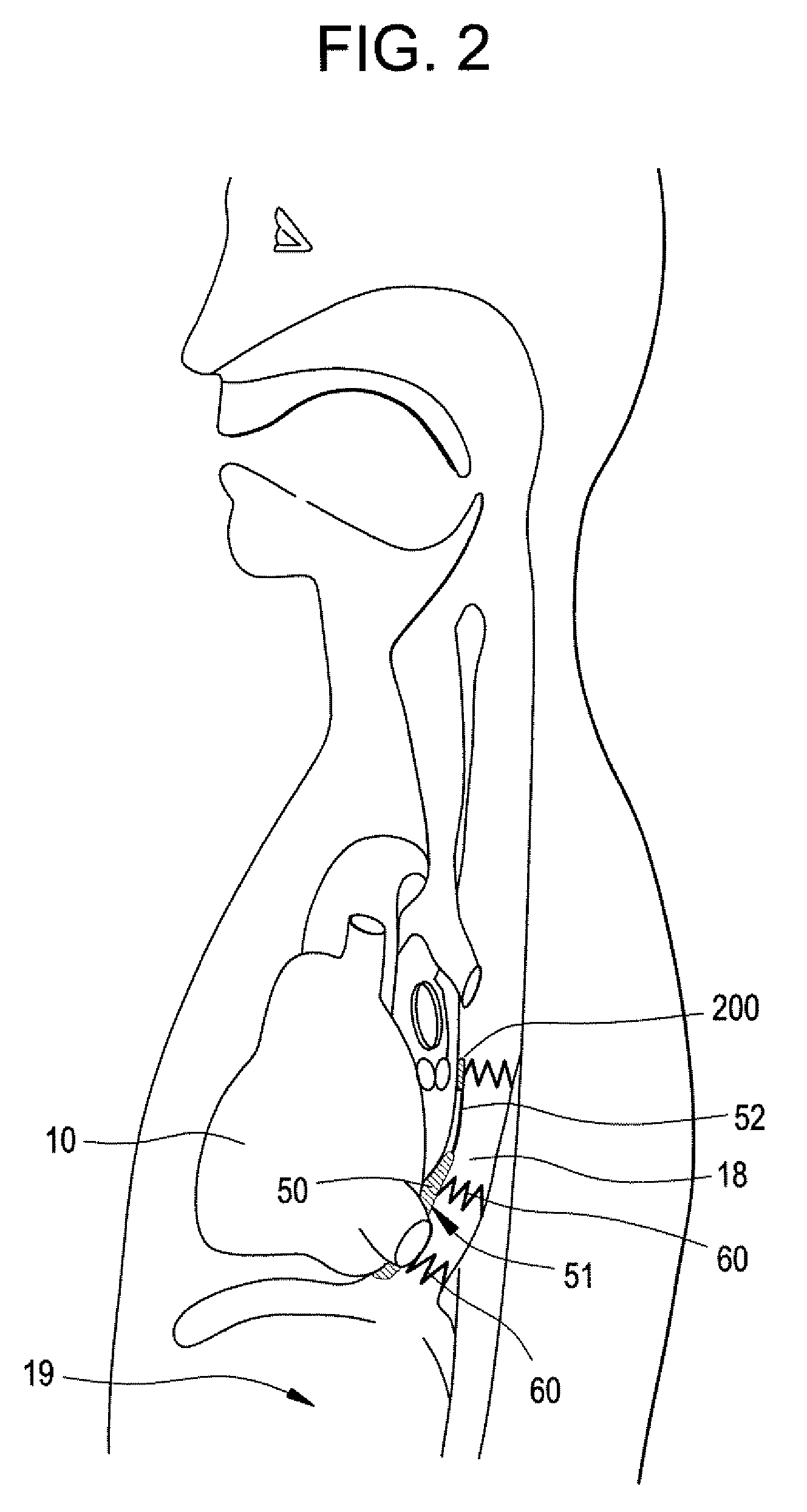 Implantable Devices and Methods for Stimulation of Cardiac or Other Tissues