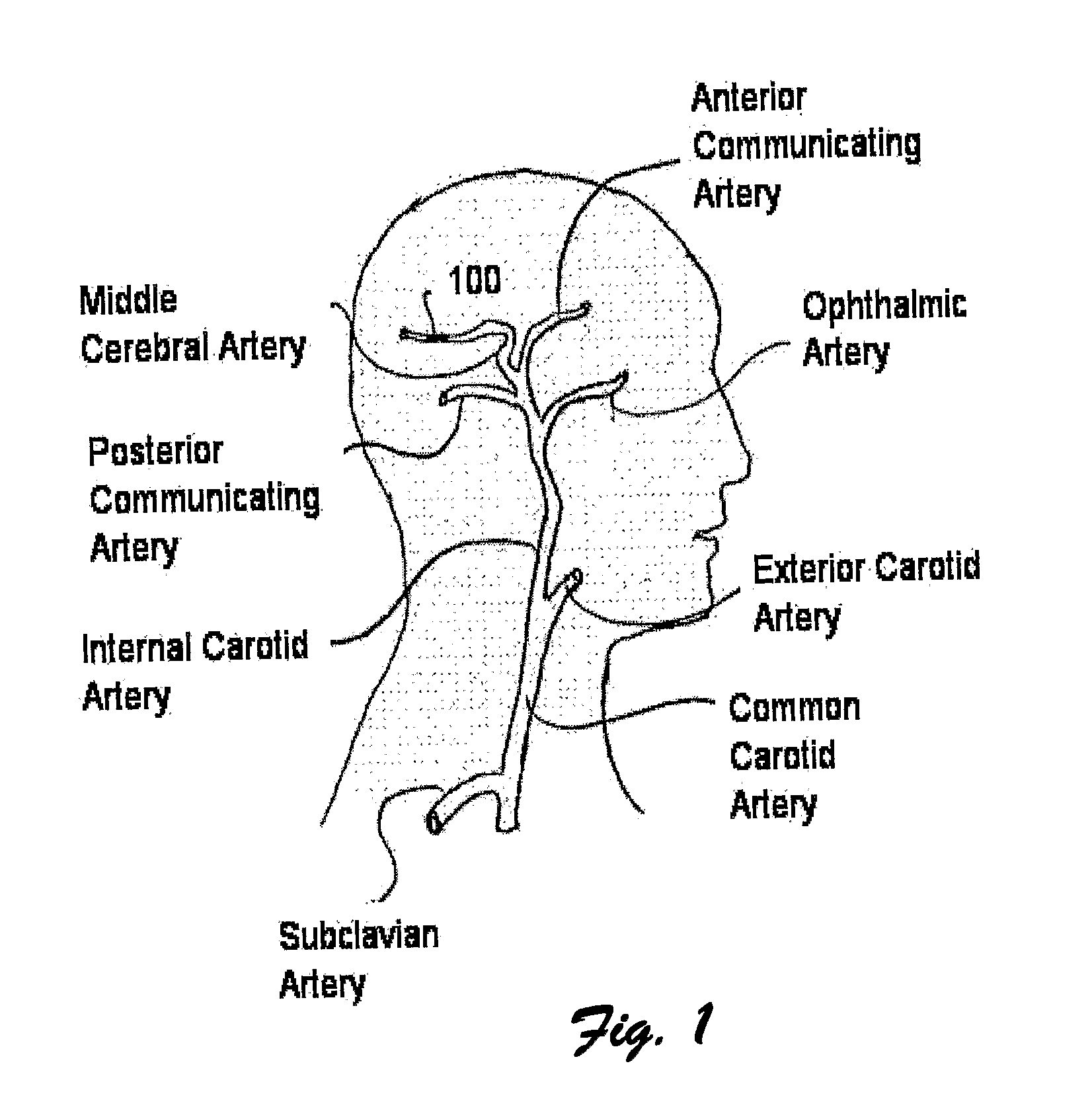 Embolectomy Device With Optional Vibrator