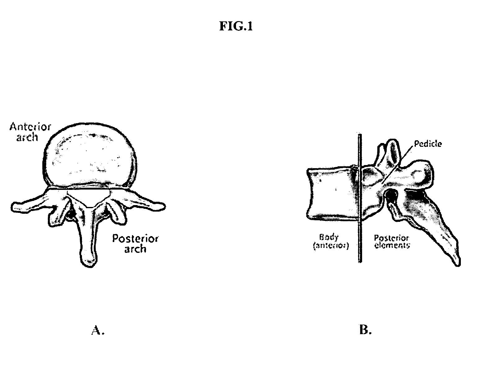Methods of employing calcium phosphate cement compositions and osteoinductive proteins to effect vertebrae interbody fusion absent an interbody device