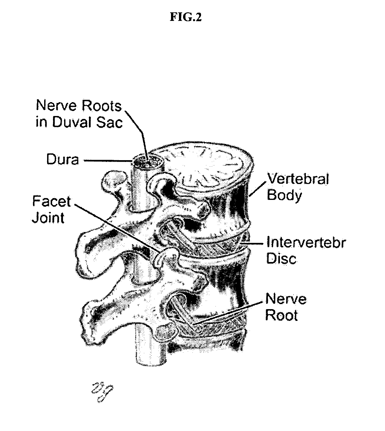 Methods of employing calcium phosphate cement compositions and osteoinductive proteins to effect vertebrae interbody fusion absent an interbody device
