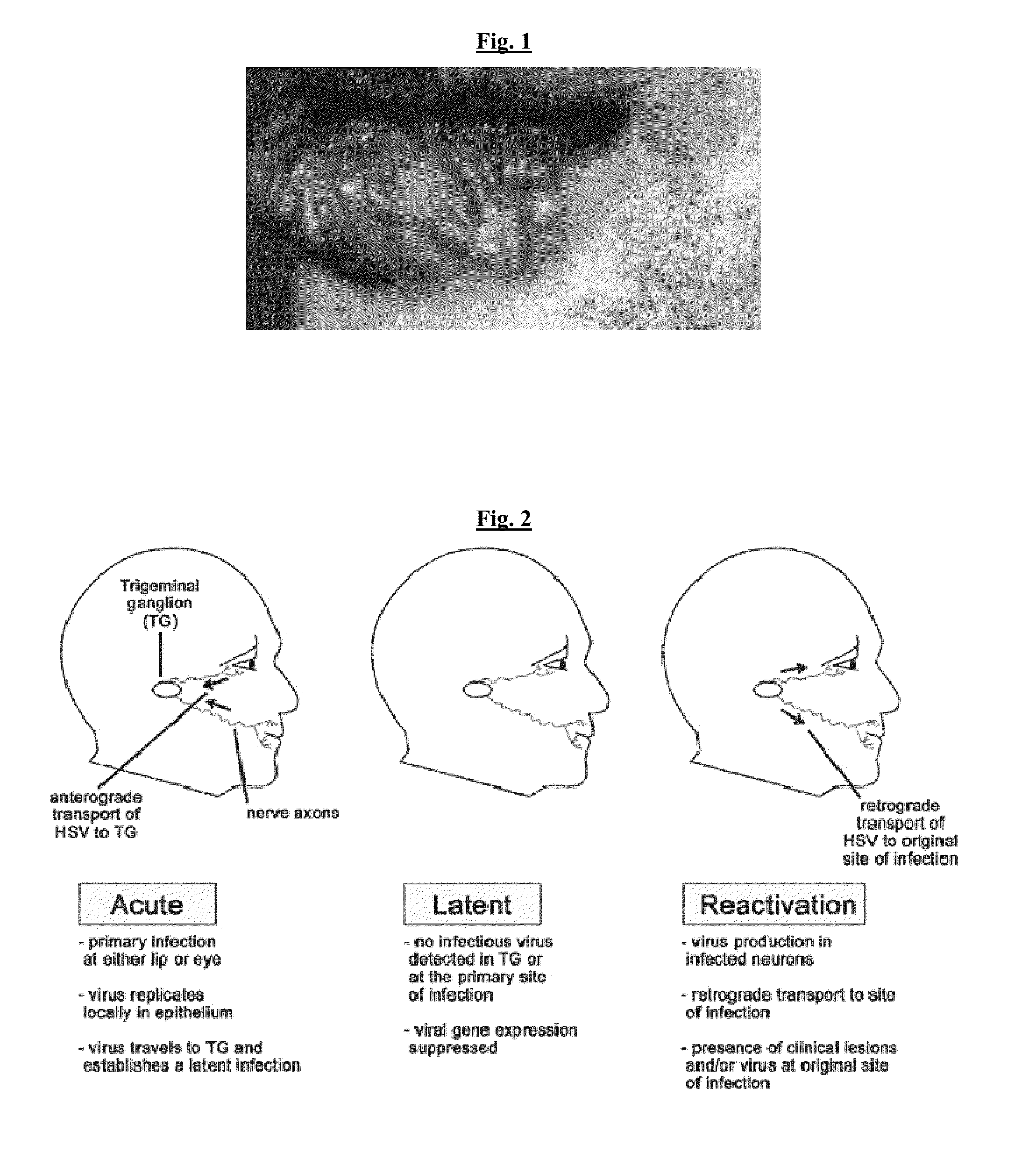 Compositions Useful for Treating Herpes Simplex Labialis and/or Herpes Esophagitis, and Methods Using Same