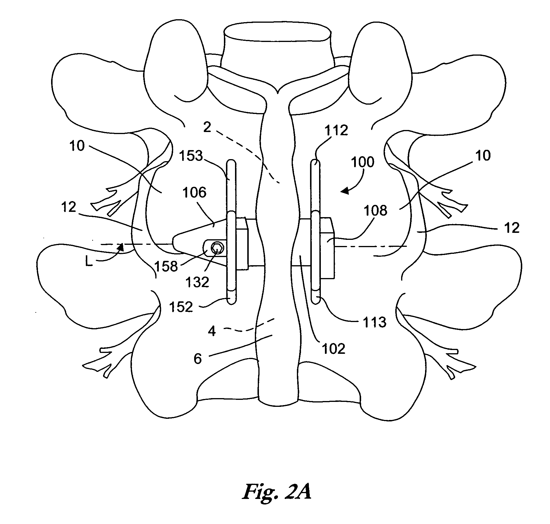Interspinous process implant including a binder and method of implantation