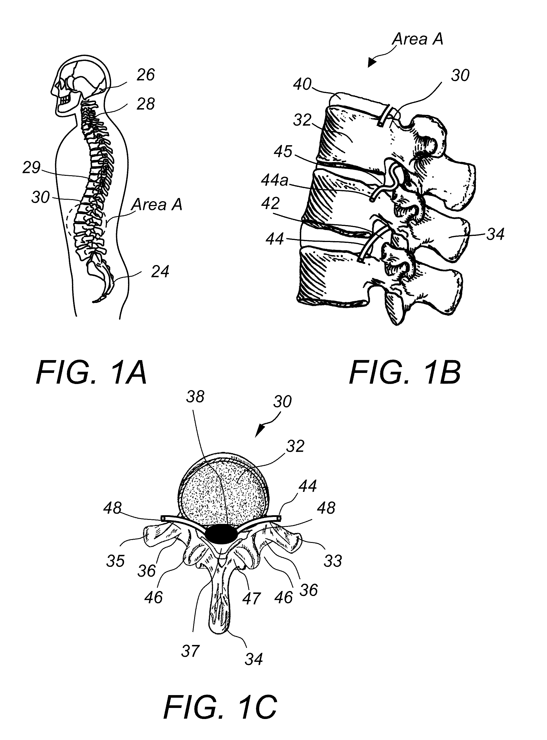 Spinous process fixation implant