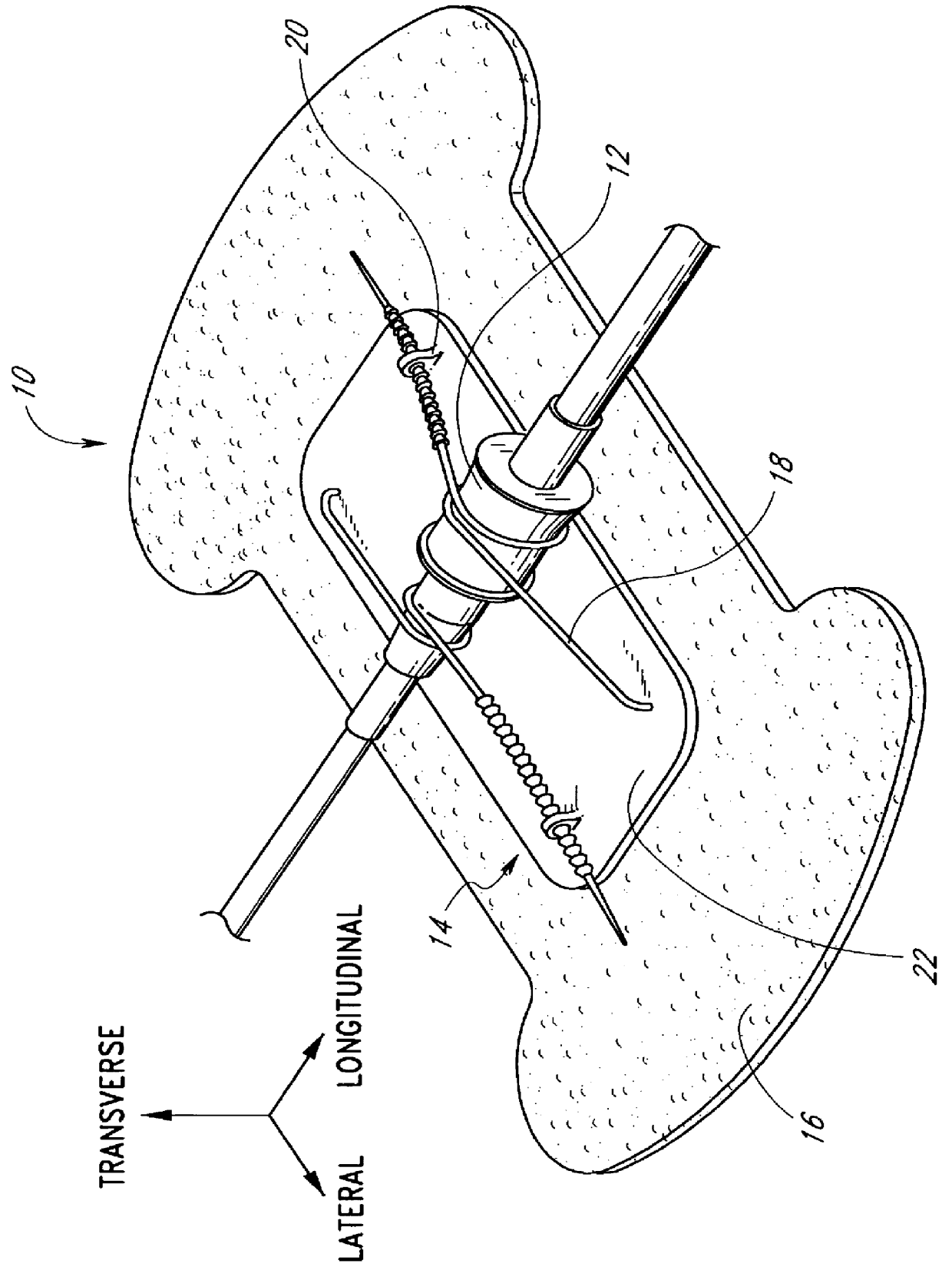Catheter securement device