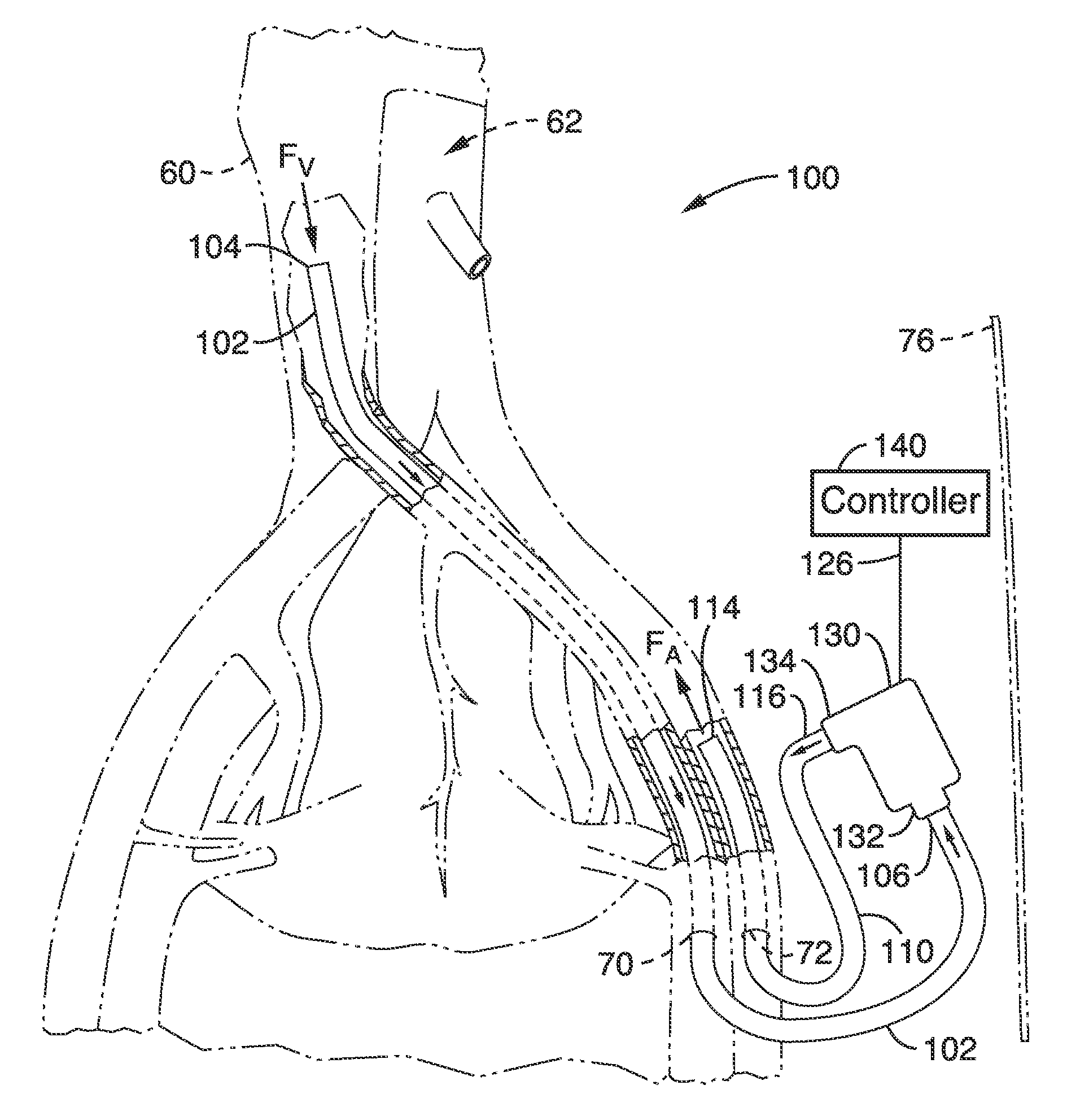 Methods and devices for treating heart failure