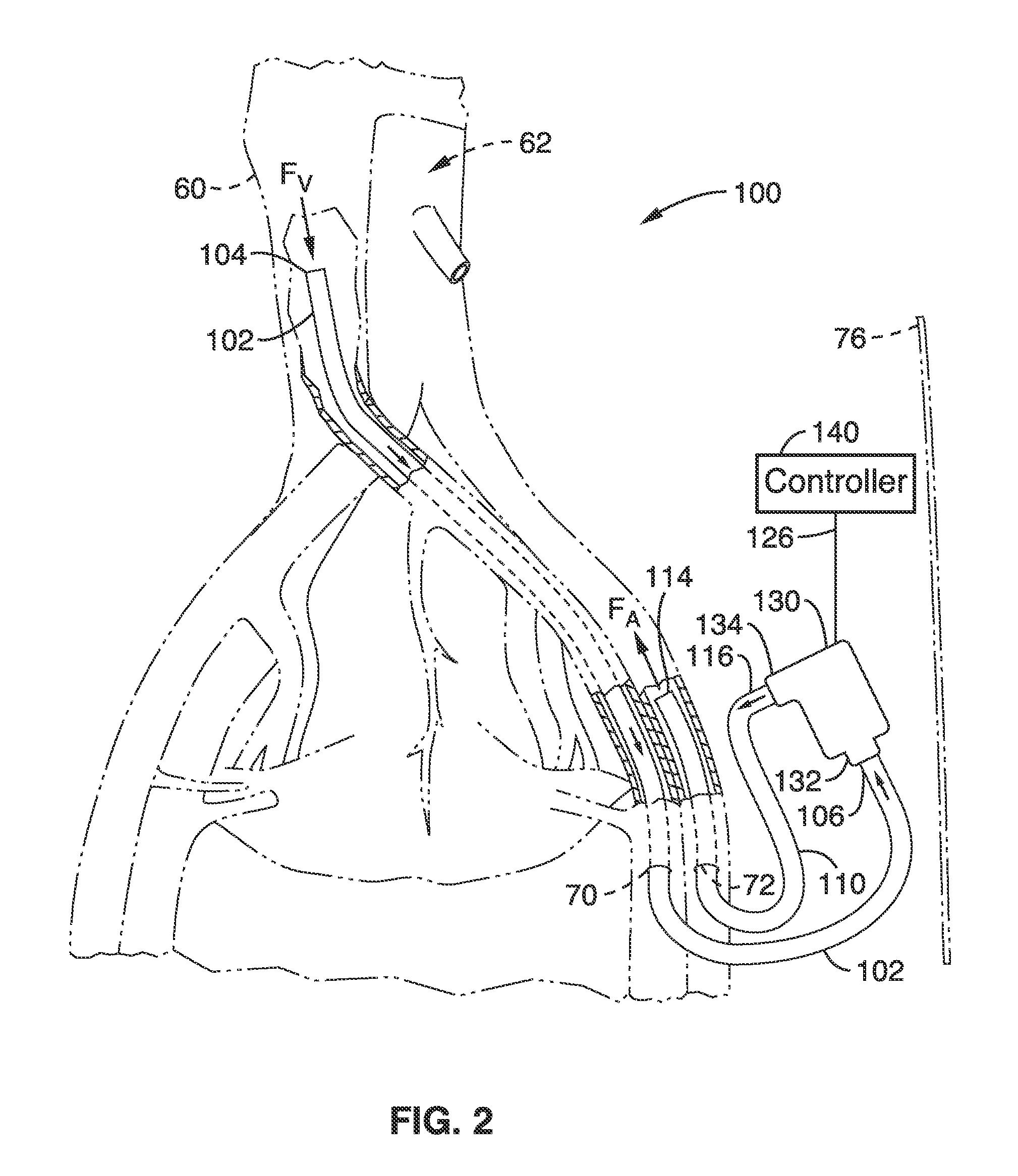 Methods and devices for treating heart failure