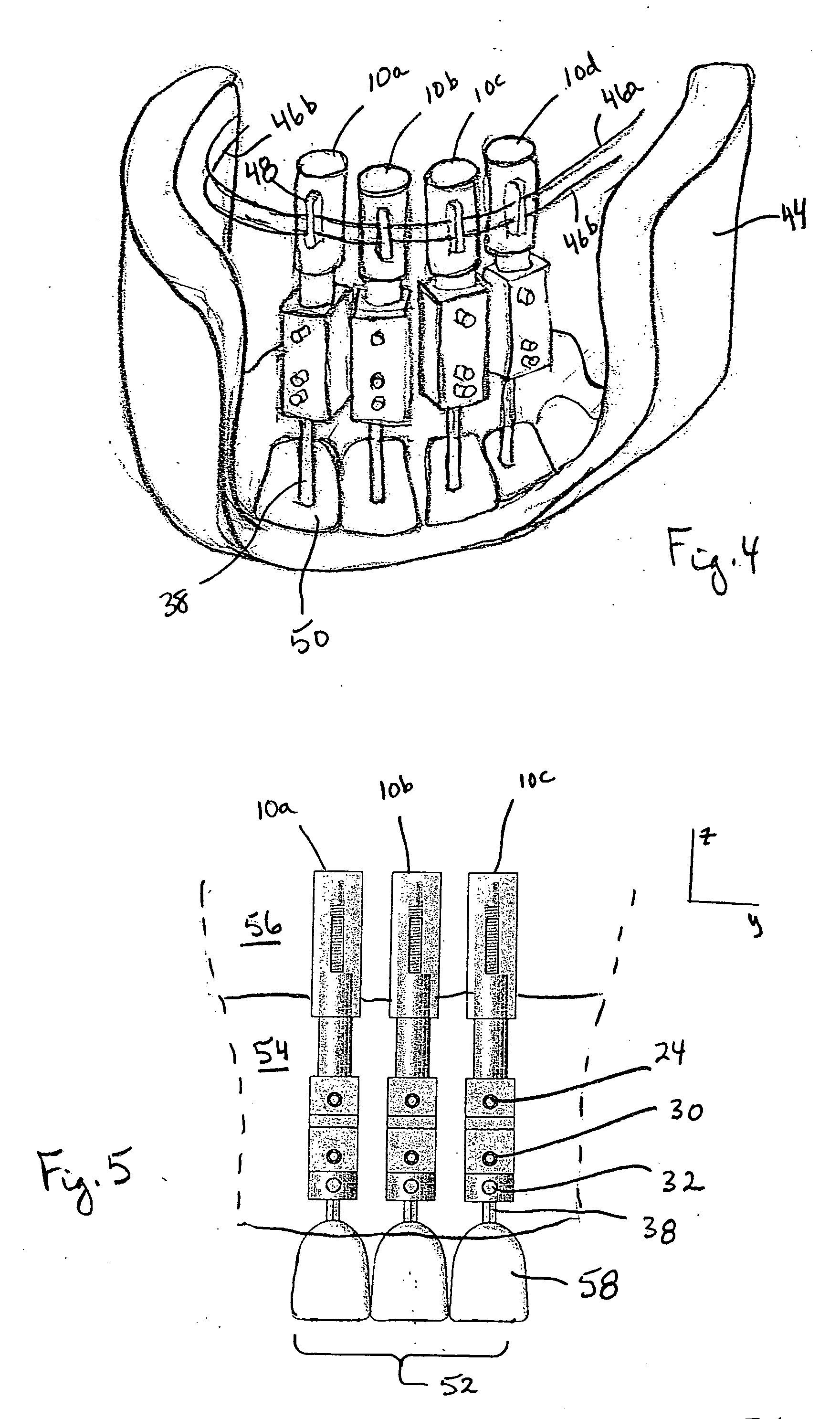 Method and apparatus for repositioning teeth