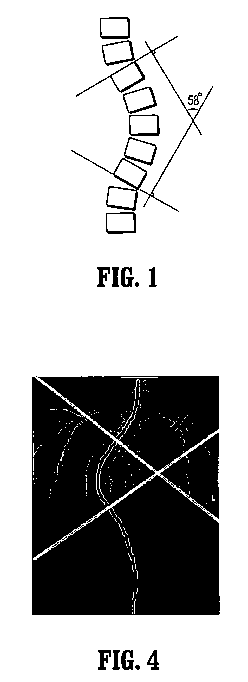 Systems and methods for computer aided detection of spinal curvature using images and angle measurements
