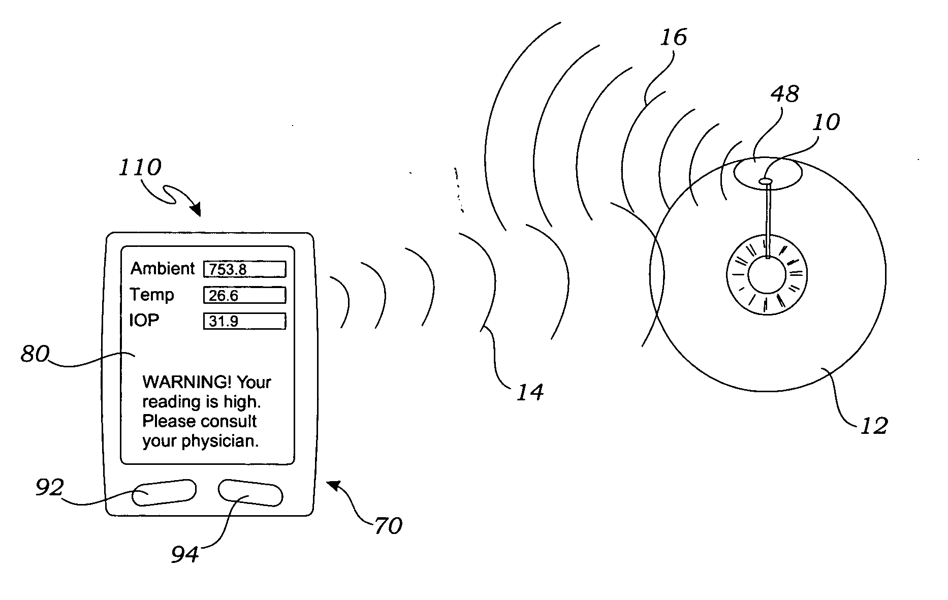 Intraocular pressure sensor