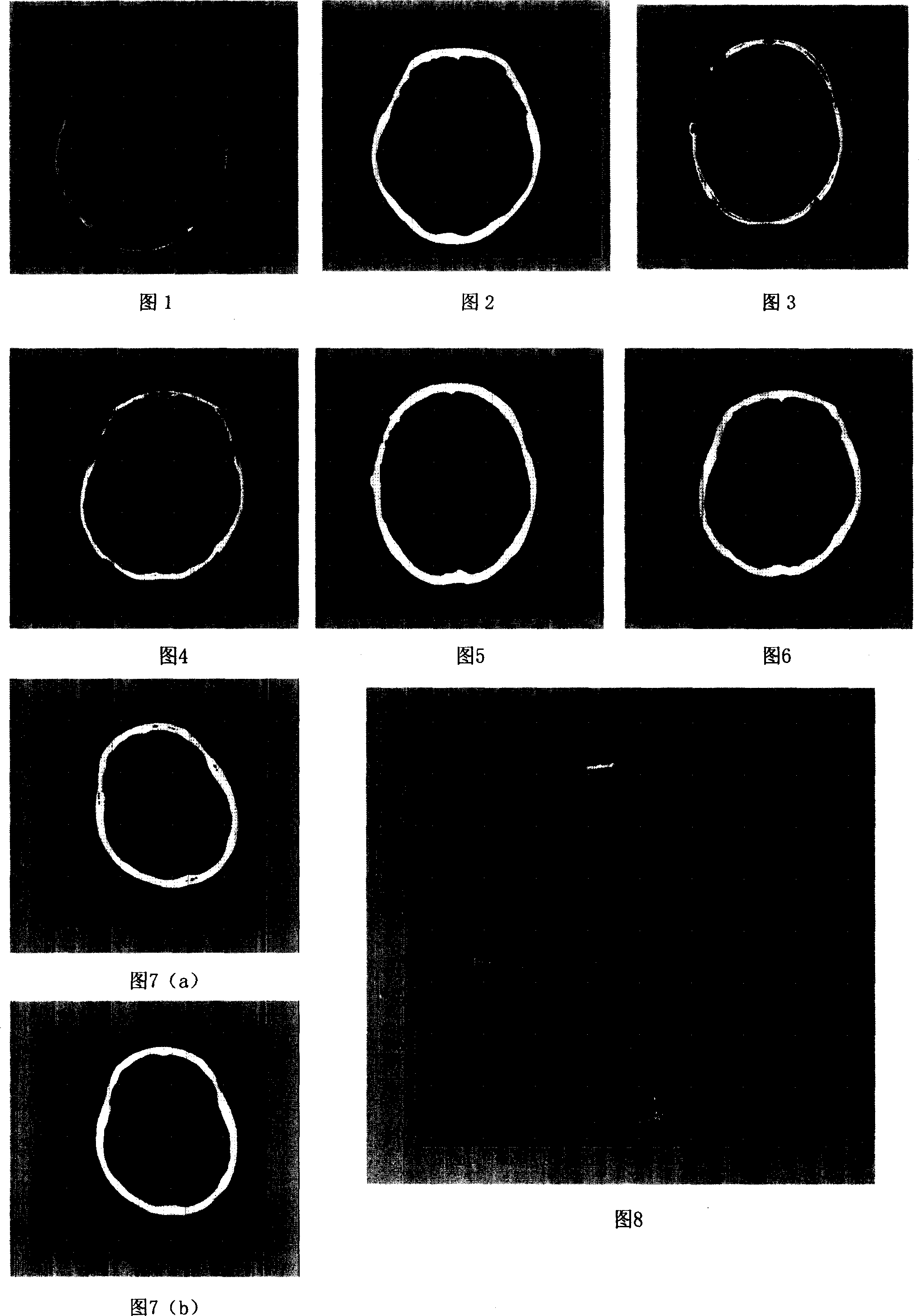 Auxiliary computer measuring method base on skull bone CT image