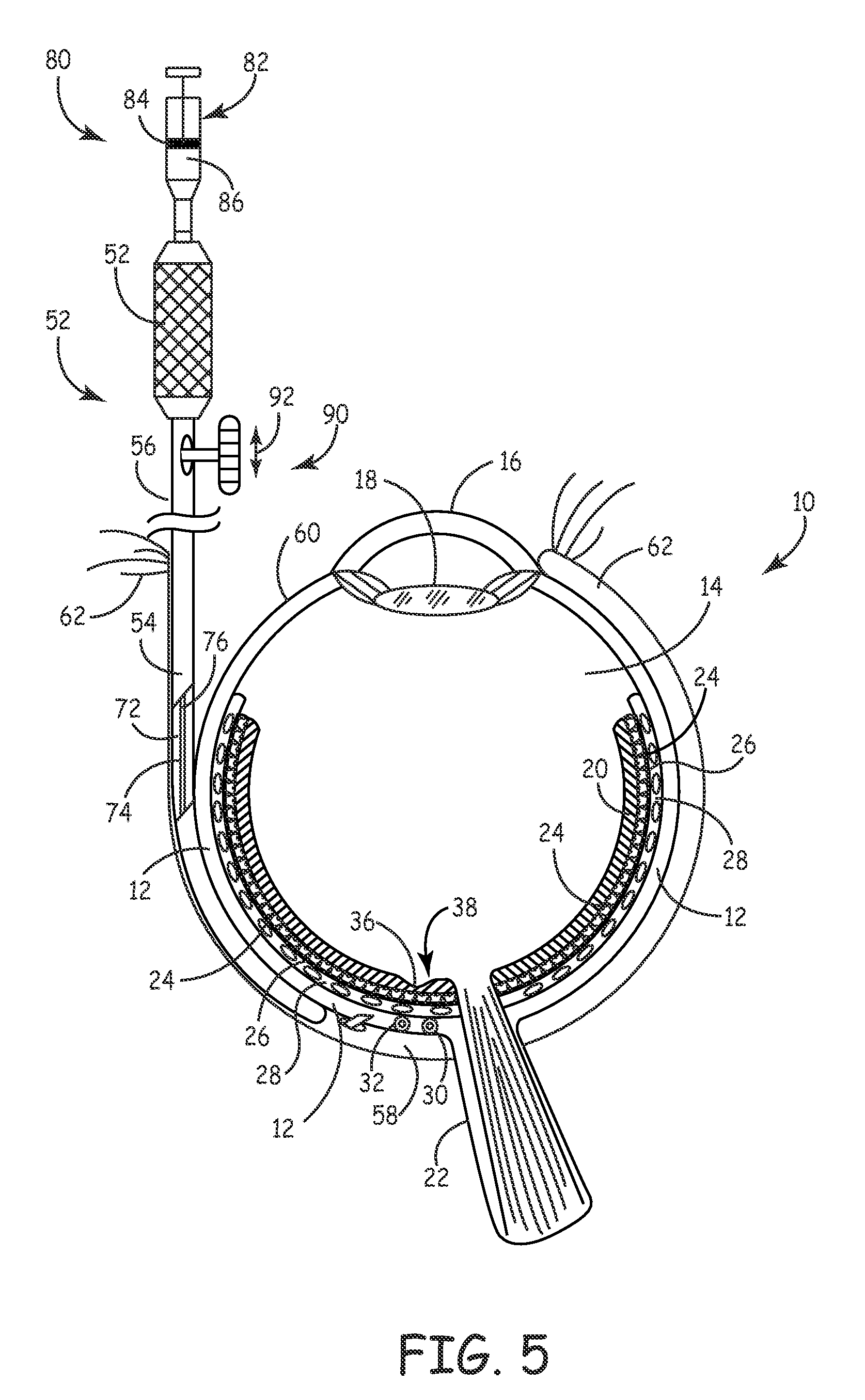 Method for treatment of macular degeneration