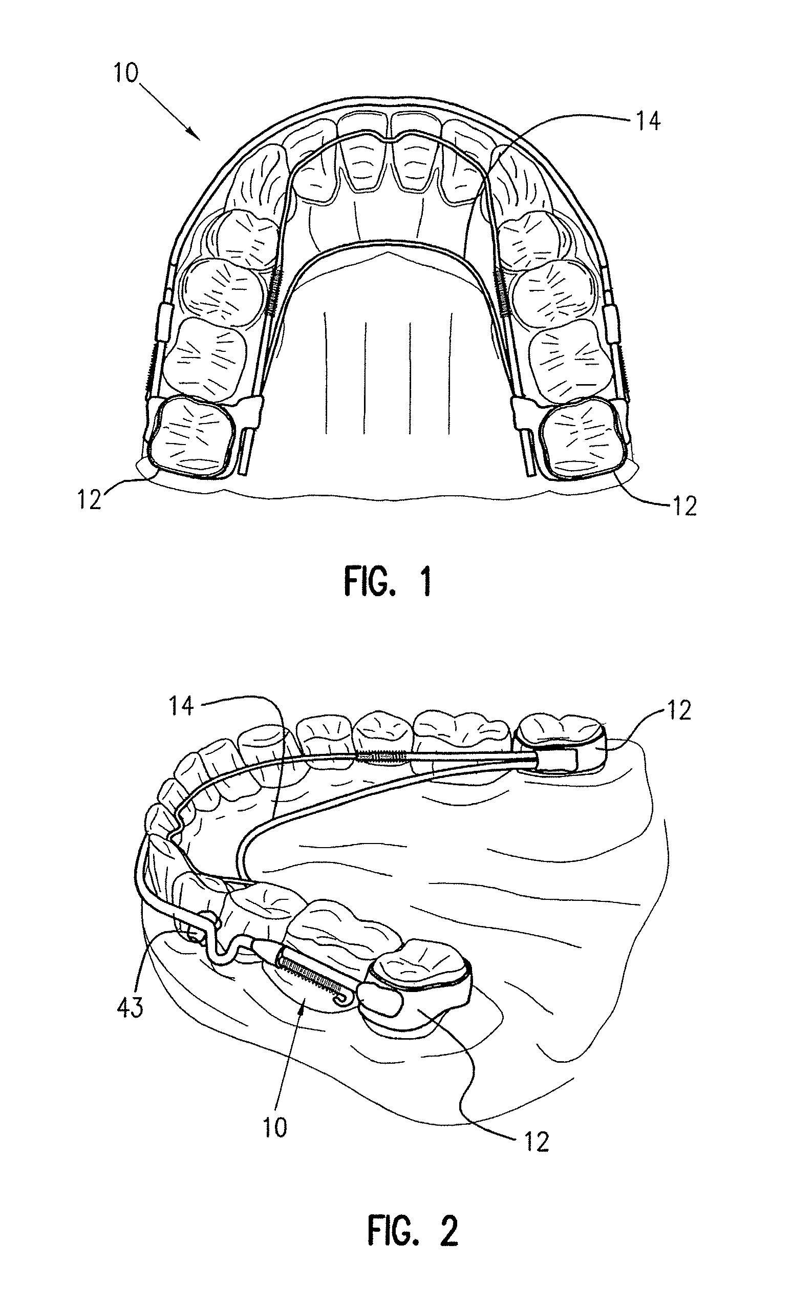 Orthodontic appliance and method