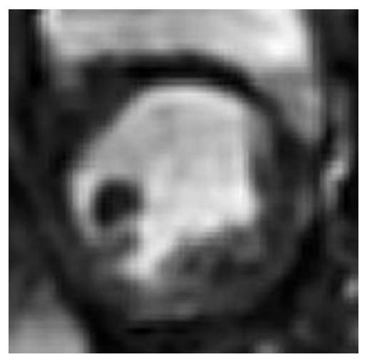 A Registration Method of Cardiac Perfusion Magnetic Resonance Images