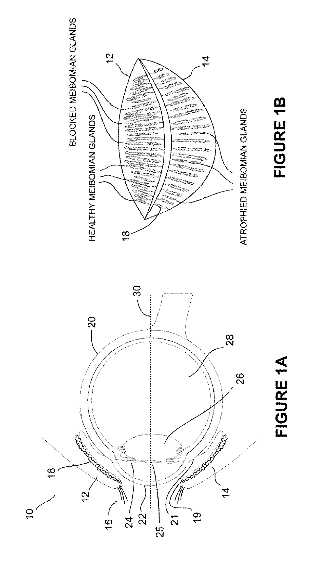 Systems and Methods For the Treatment of Eye Conditions