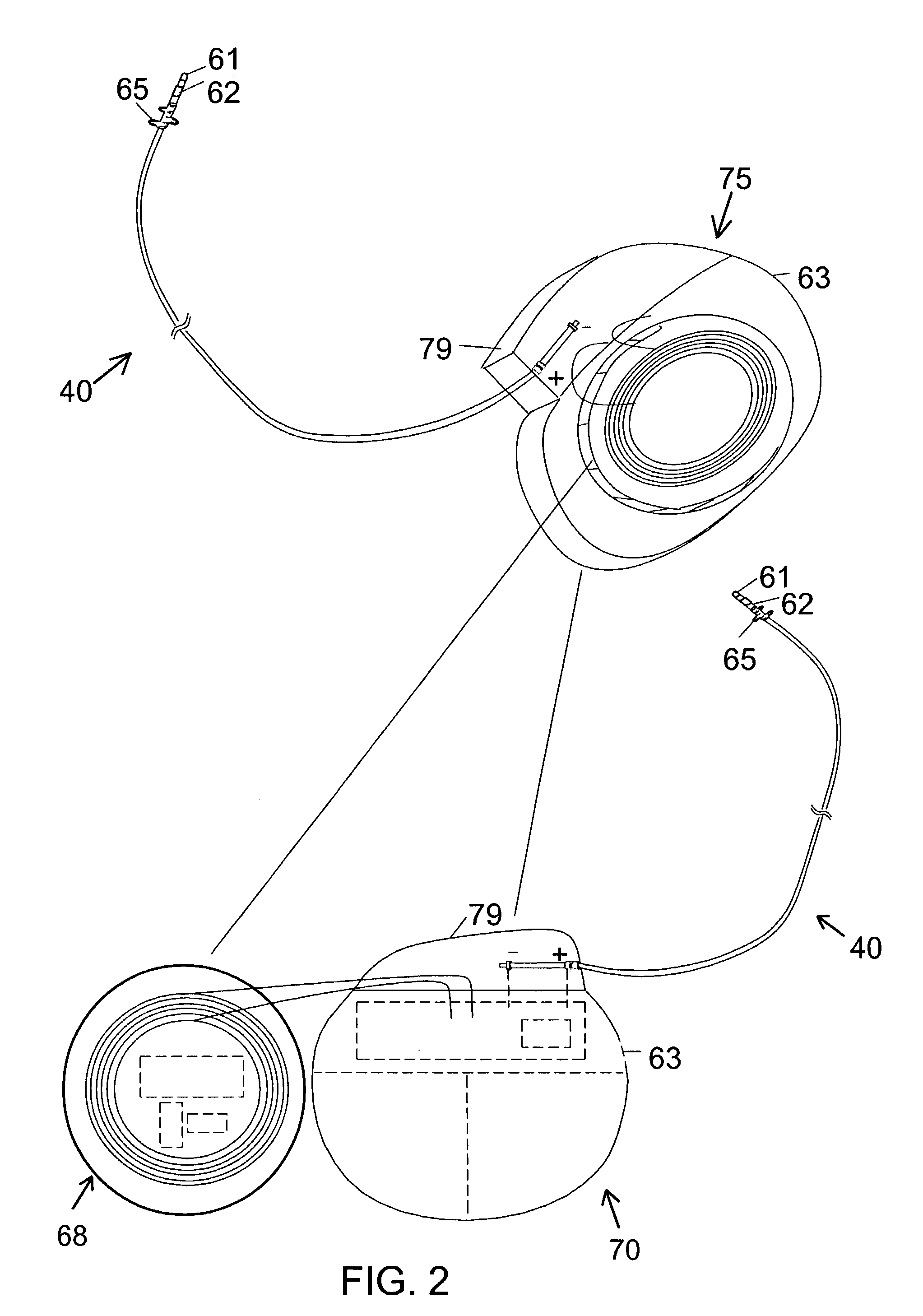 Method and system for providing pulsed electrical stimulation to sacral plexus of a patient to provide therapy for urinary incontinence and urological disorders