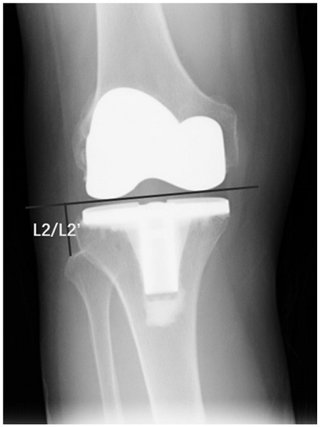 Total knee arthroplasty post-operation revision pre-operation planning method based on deep learning