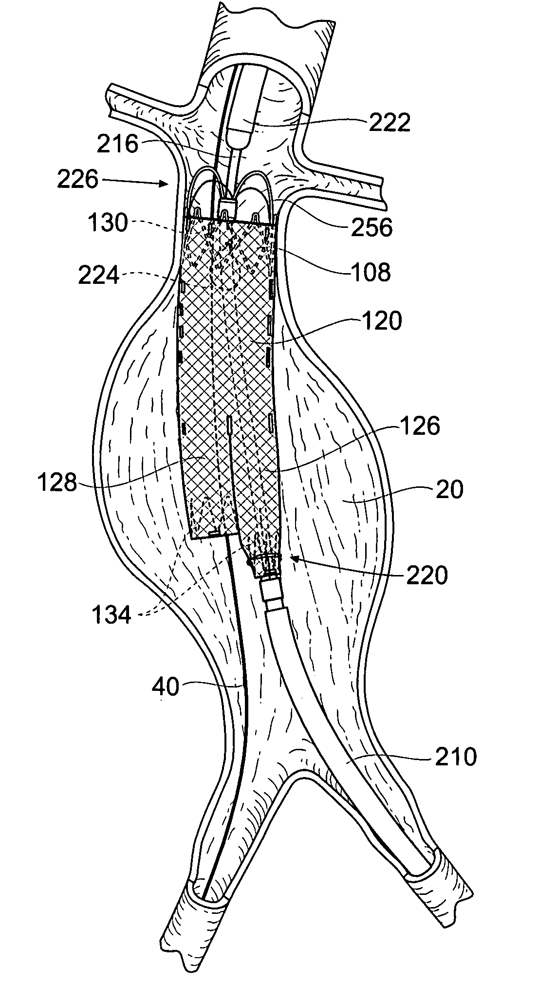 Devices, systems, and methods for prosthesis delivery and implantation