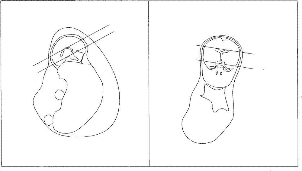 Method for positioning three axial positions of fetal brain through nuclear magnetic resonance