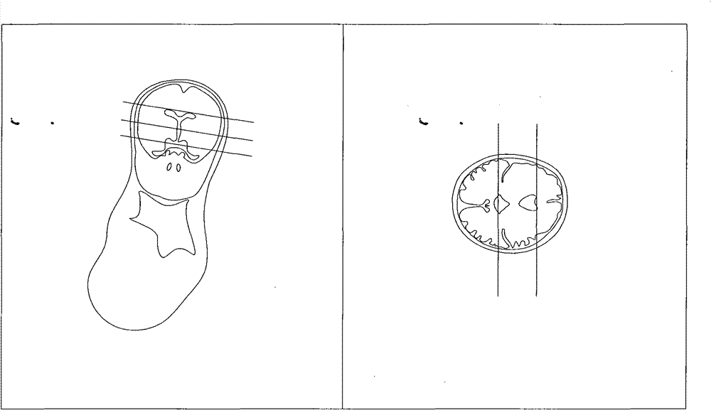 Method for positioning three axial positions of fetal brain through nuclear magnetic resonance