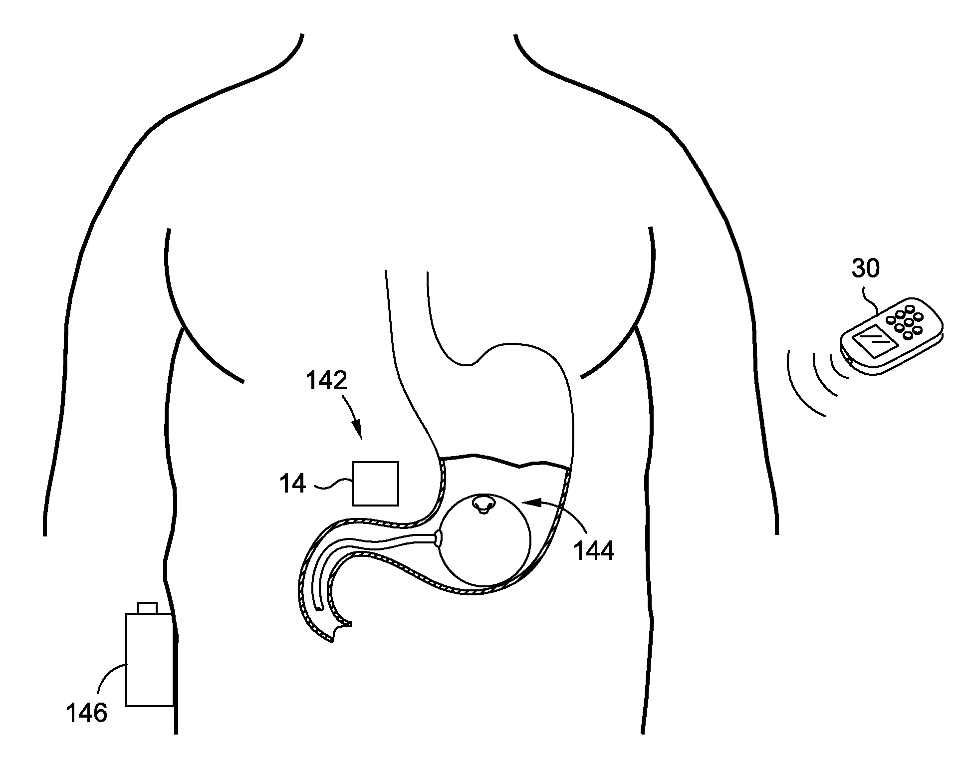 Intragastric Volume Occupying Device with Active Agents