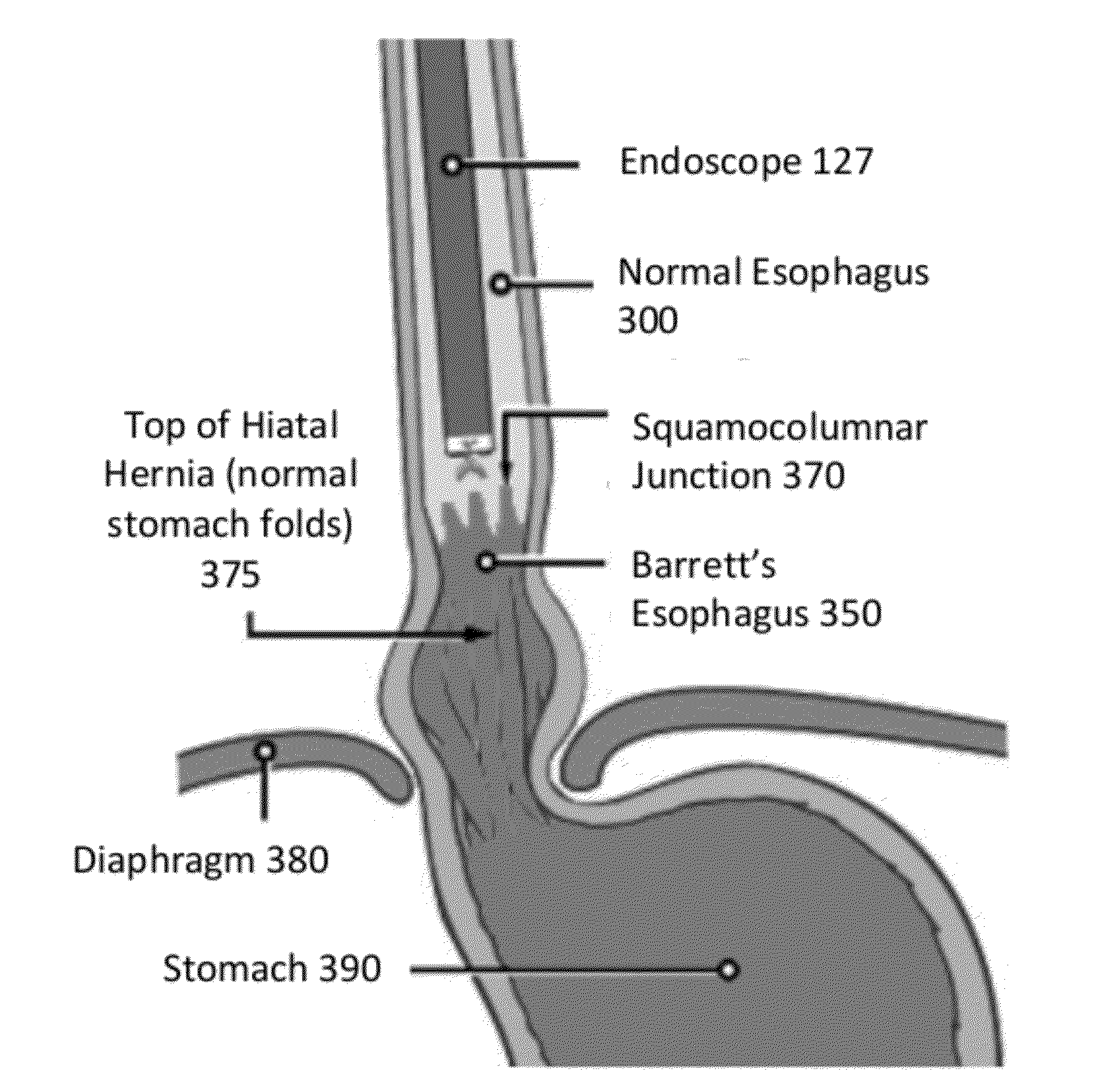 Diode laser systems and methods for endoscopic treatment of tissue