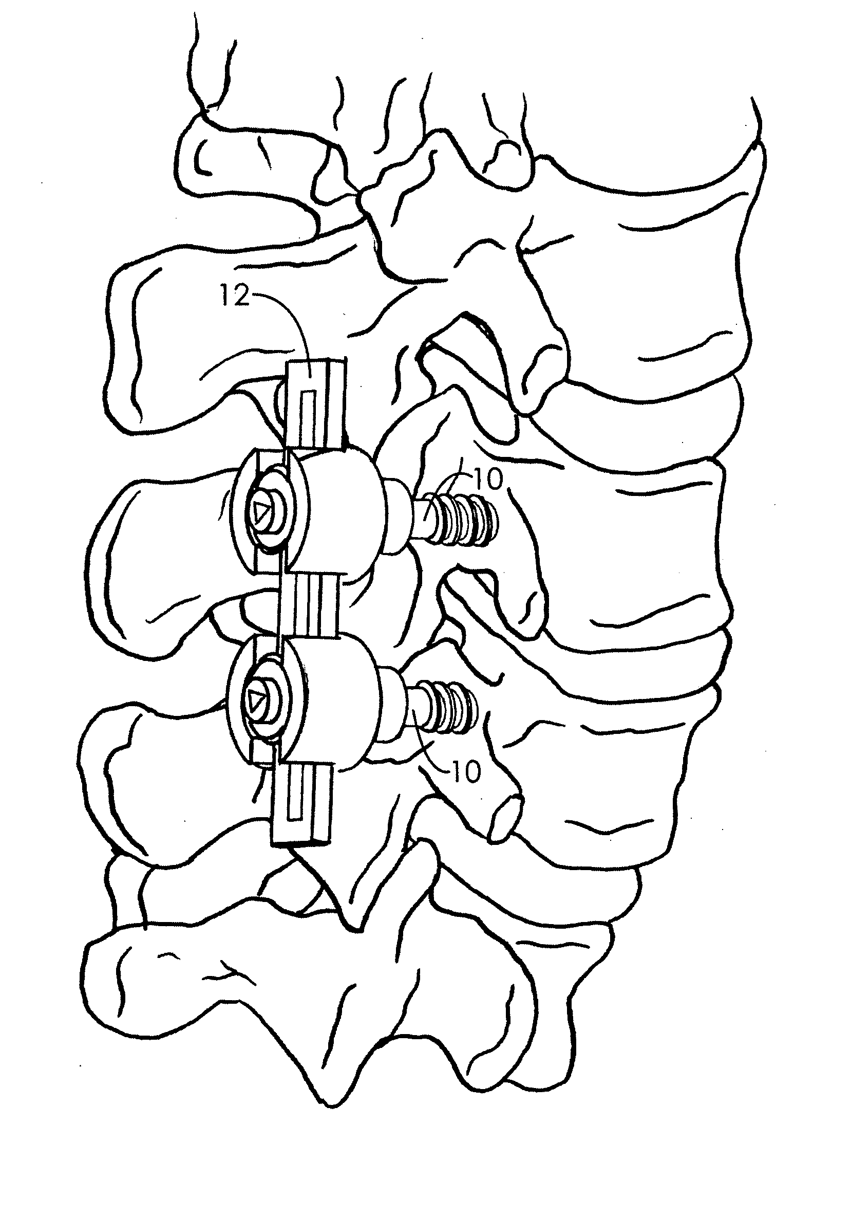 Spinal fixation system