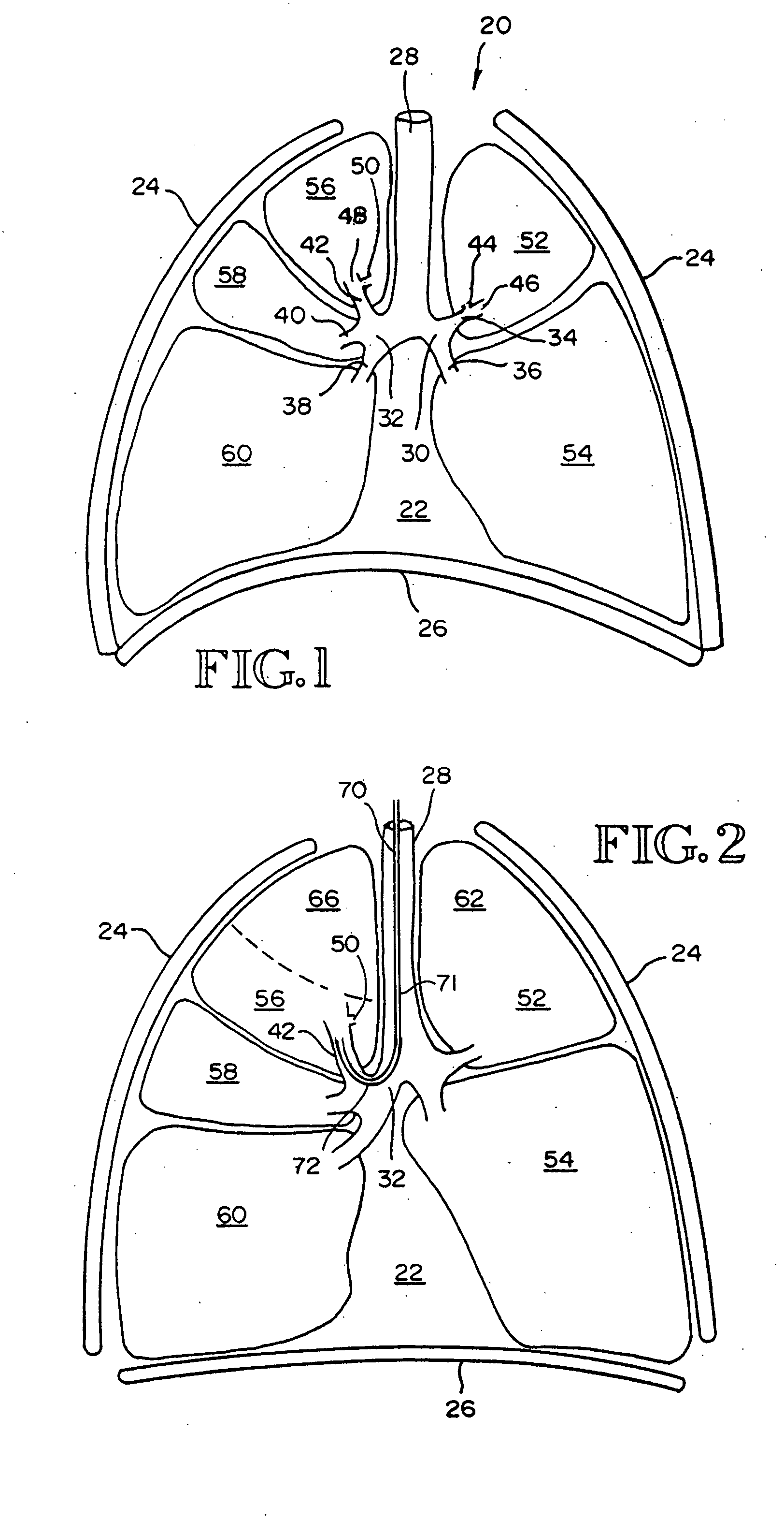 Intra-bronchial valve devices
