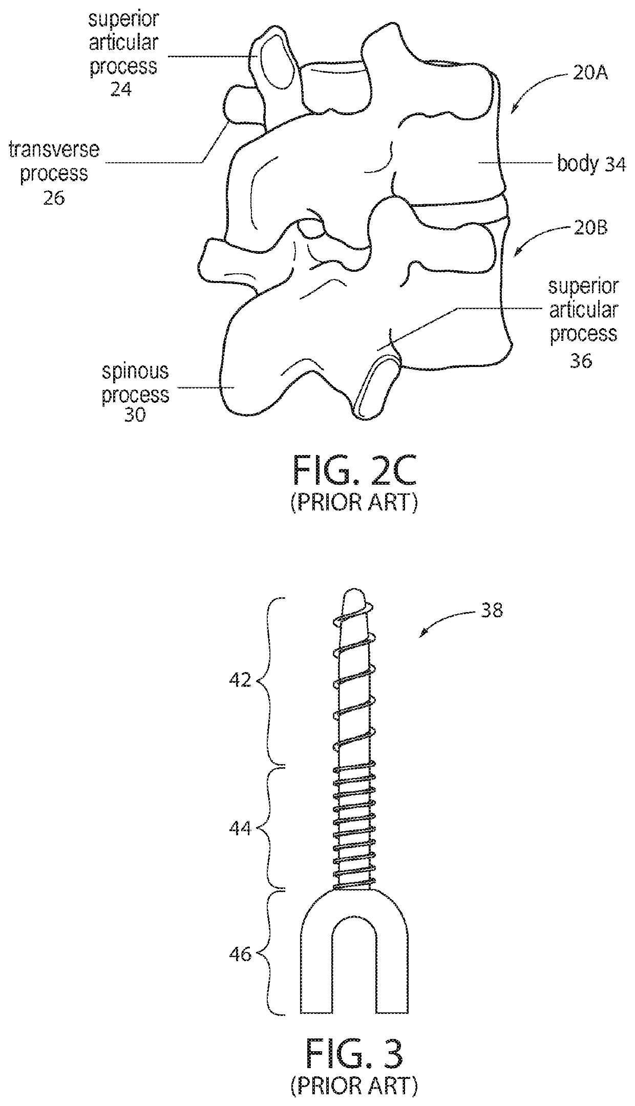 Pedicle screw placement system and method for spinal surgery