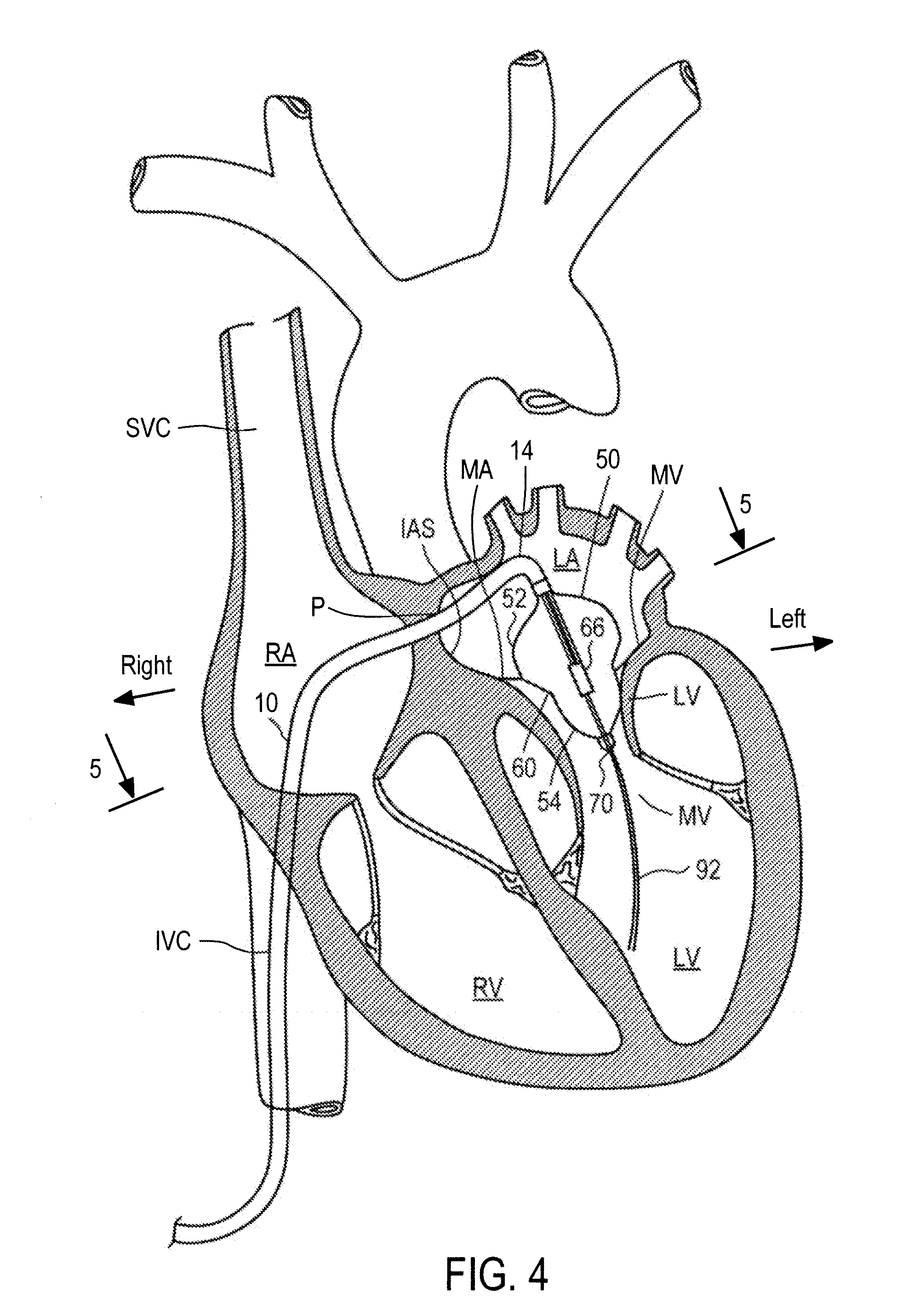 Methods and apparatus for treatment of mitral valve insufficiency