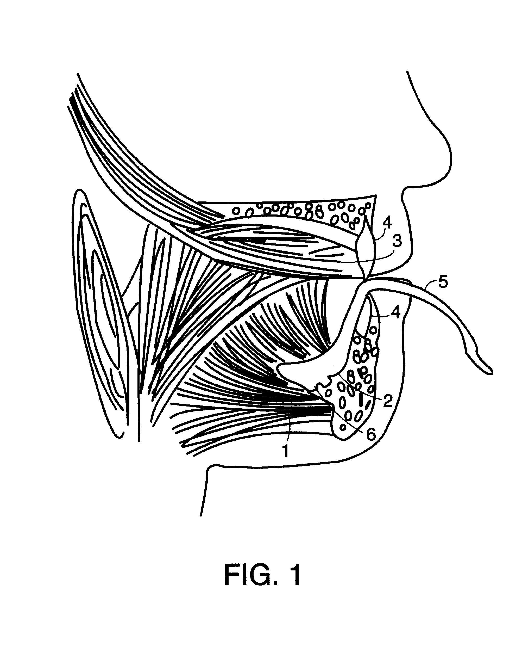 Electrode and method for measuring muscle activity in the pharyngeal airways
